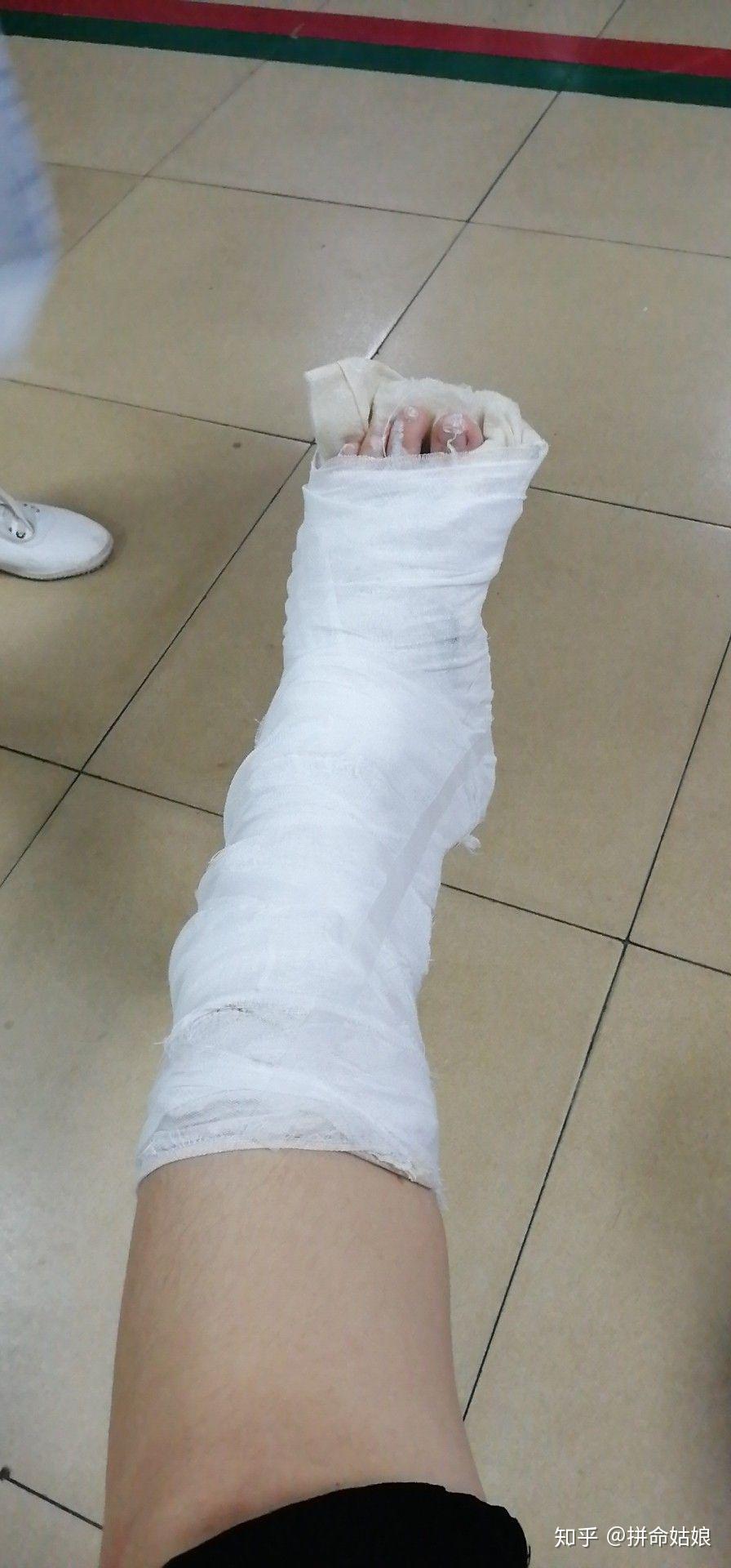 左脚第五跖骨骨折