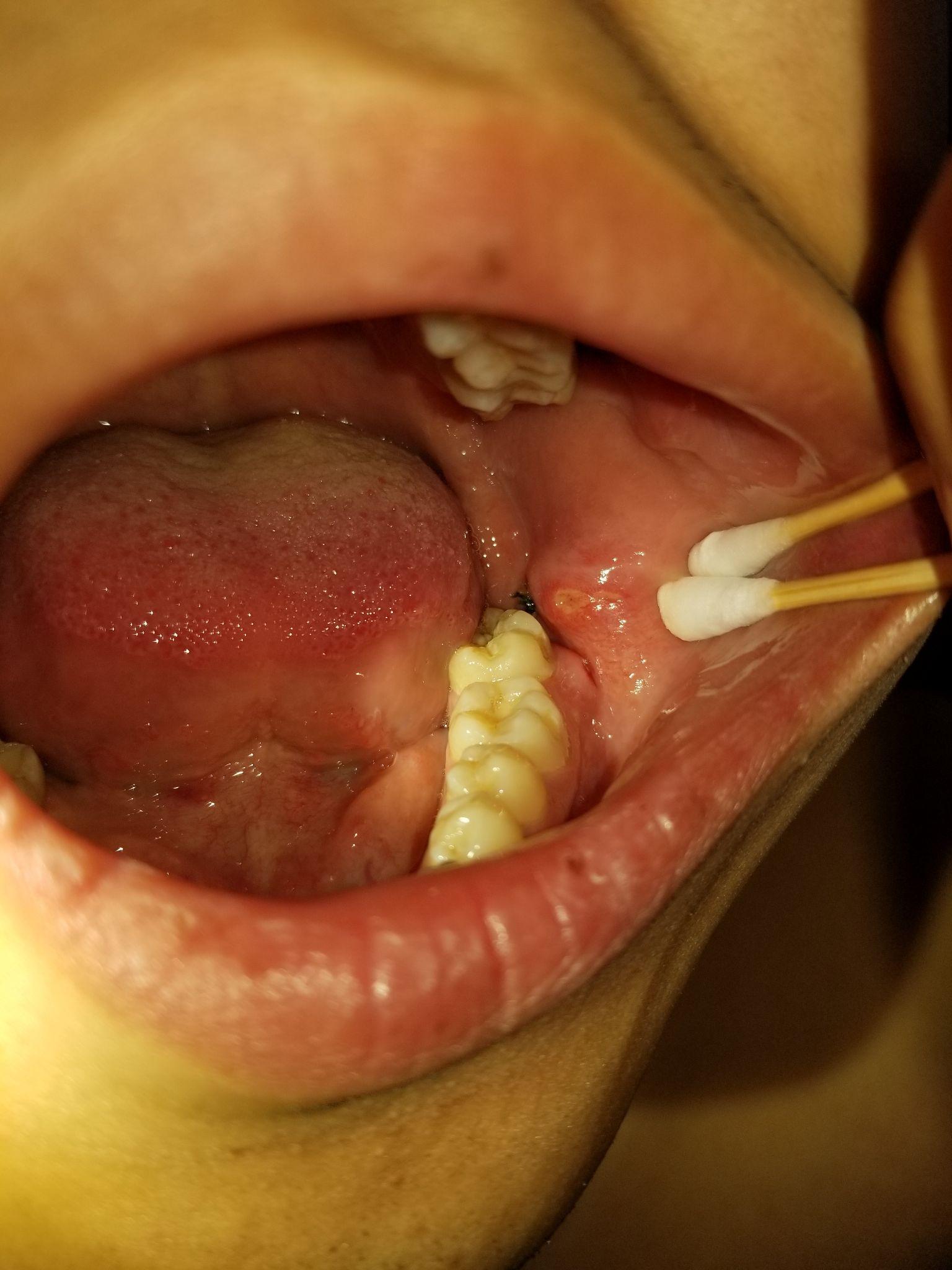 (有图慎点)拔完智齿第八天伤口附近有一大片口腔溃疡是什么?