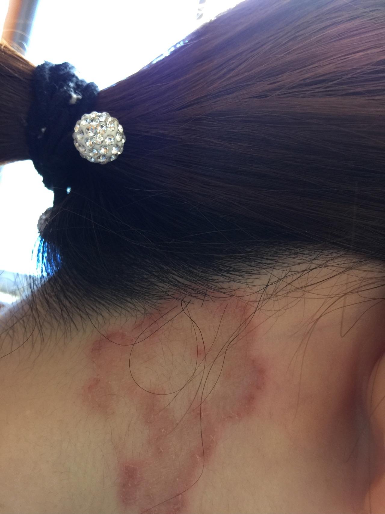 人得了猫藓怎么办