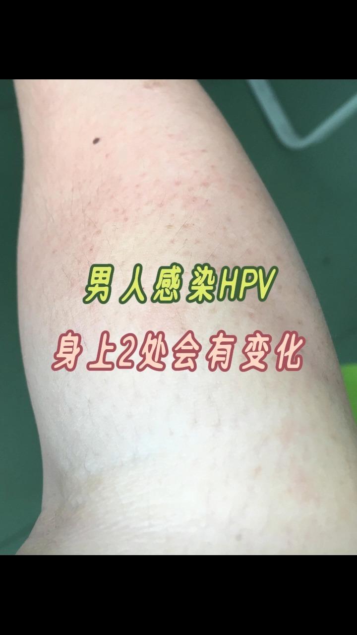 男人感染hpv,身上2处会有变化