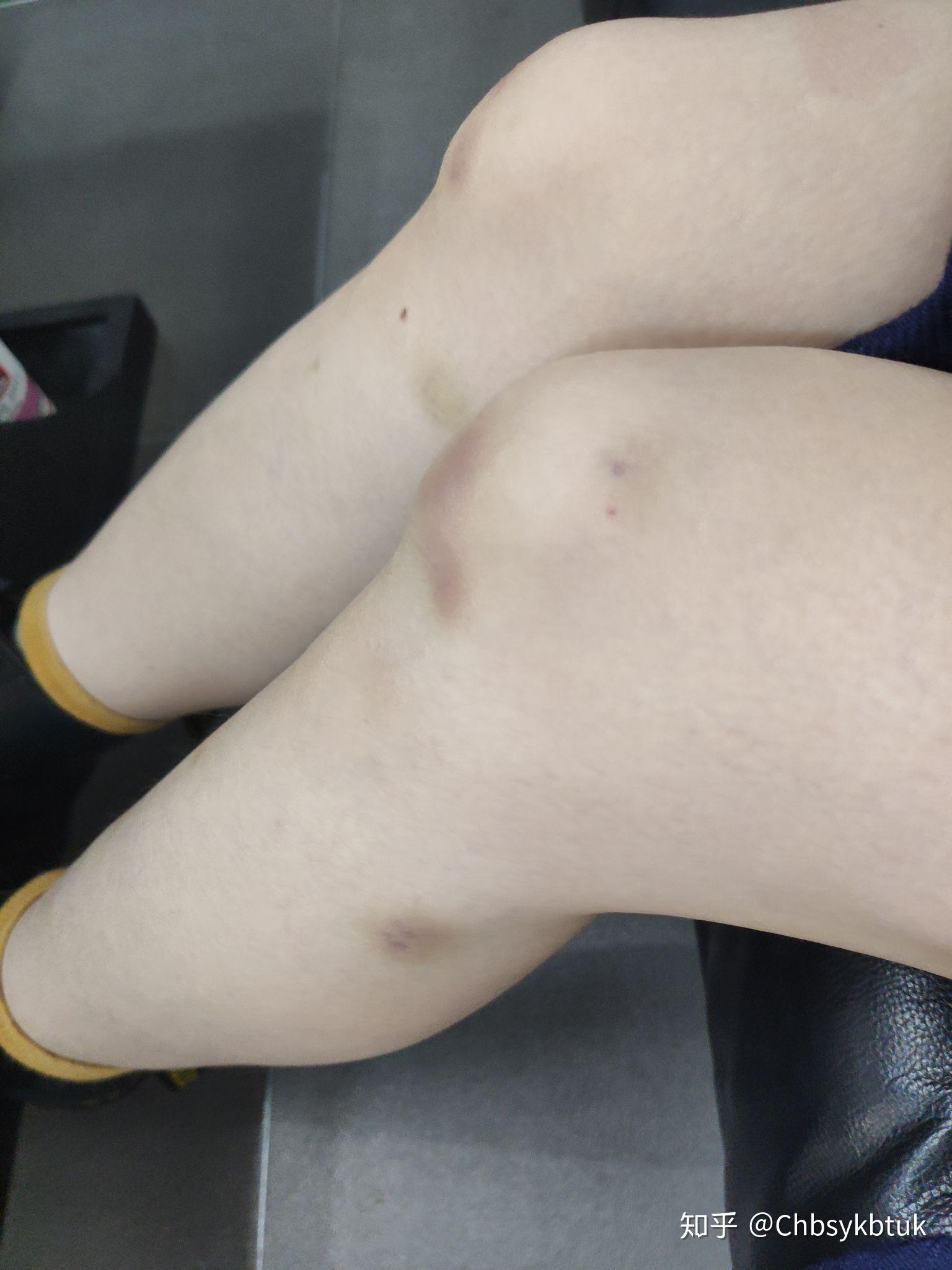 膝盖有紫红色瘀斑无痛图片