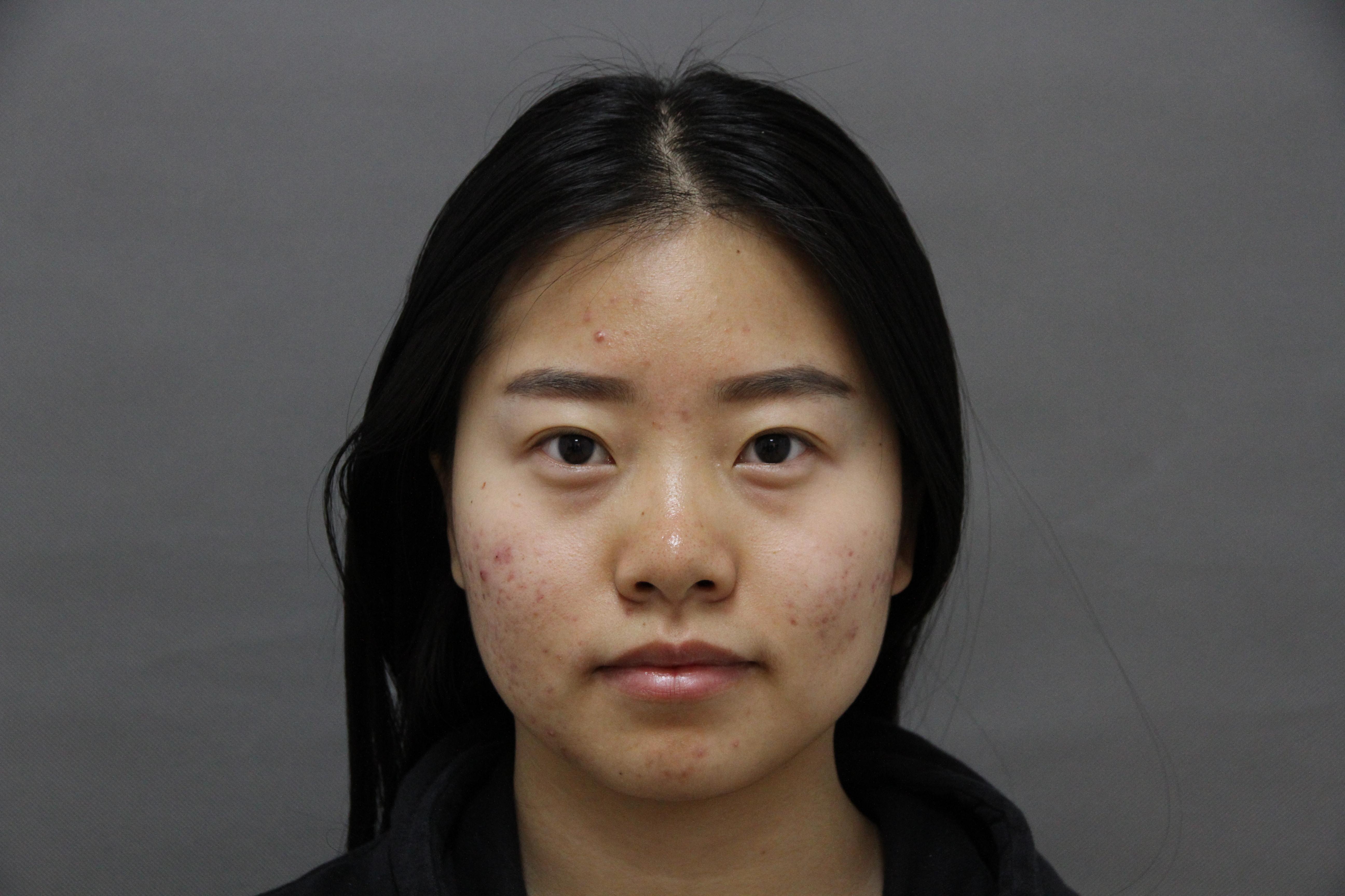 十几年的痘龄时好时坏皮肤状态非常差怎么改善或治疗有通过医美治好的