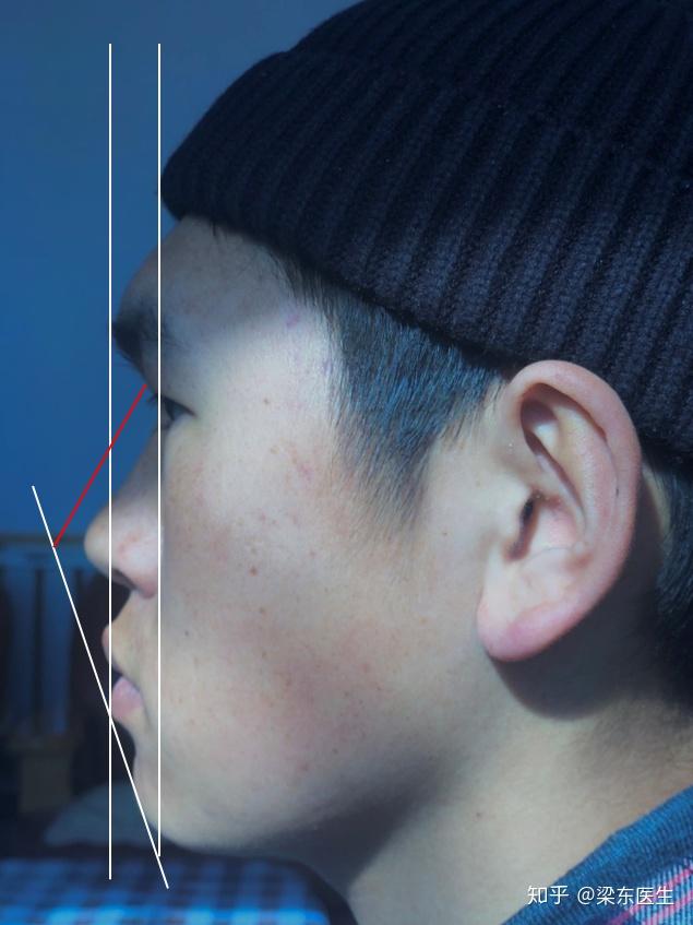侧脸不立体,眉骨比鼻尖还要突出该怎么办? - 知乎