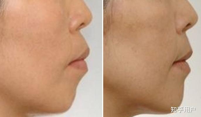 下颌骨不对称请问有矫正办法吗