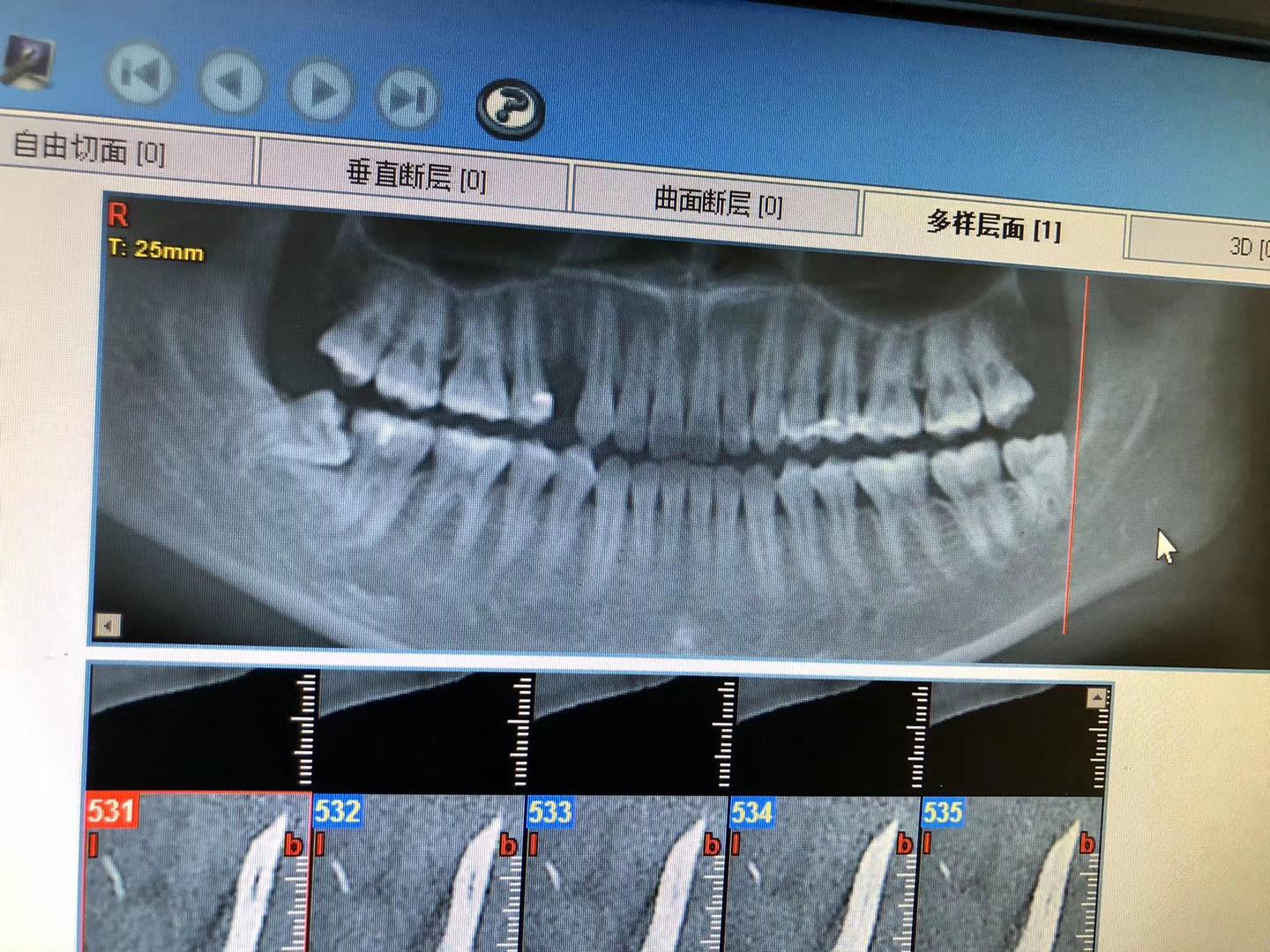 下牙這程度的智齒會棘手嗎打了麻藥拔還會痛嗎