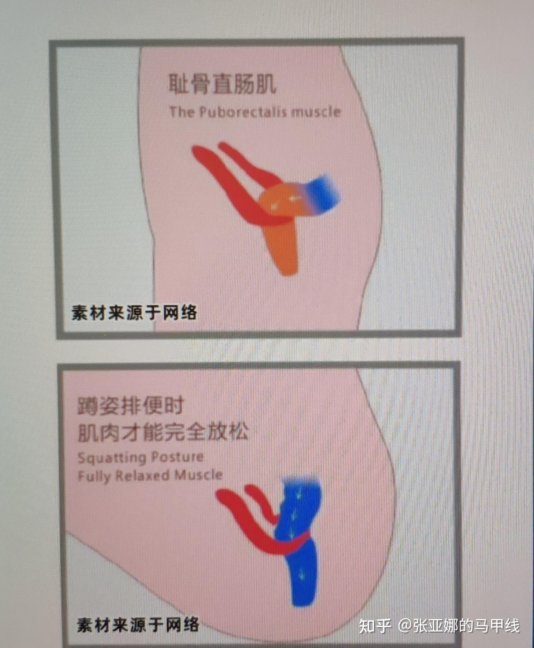 直肠前突病历模板图片