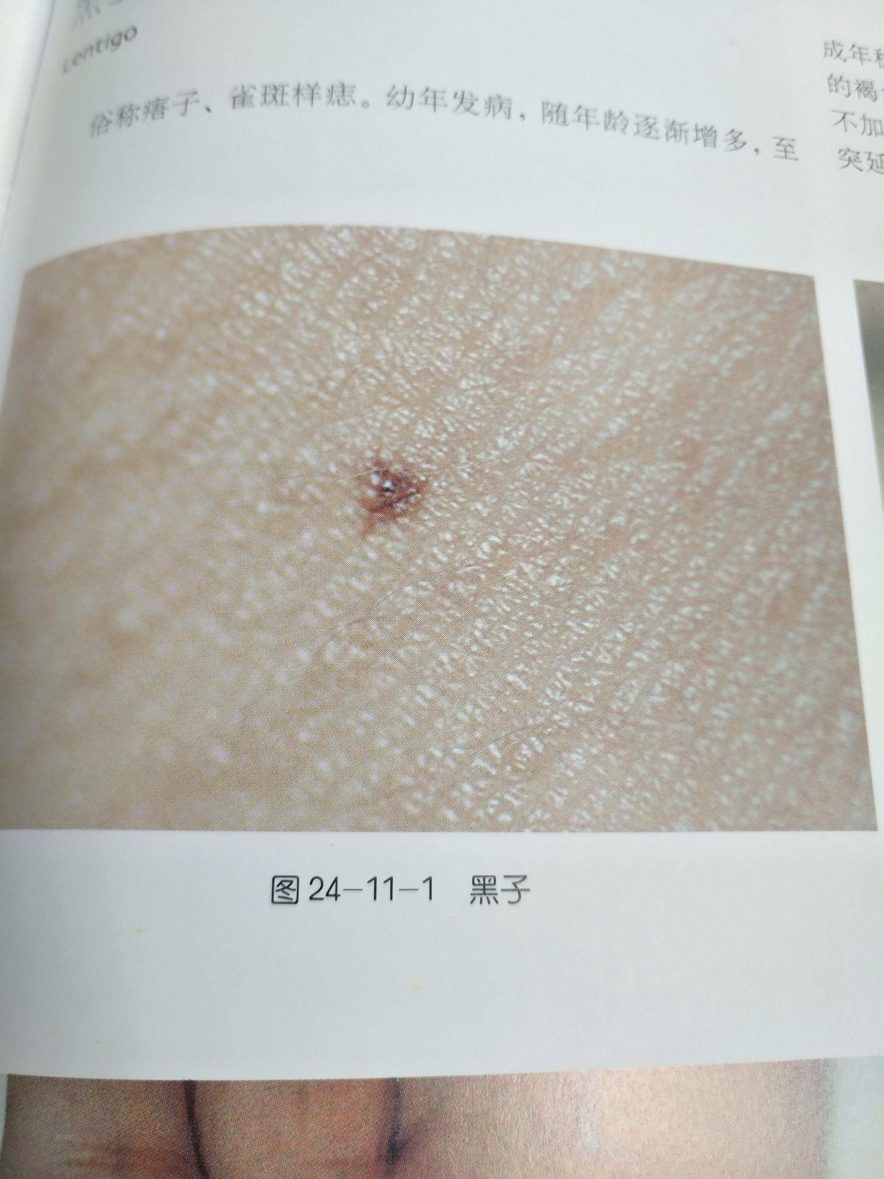 如何去除脸上的黑色素.