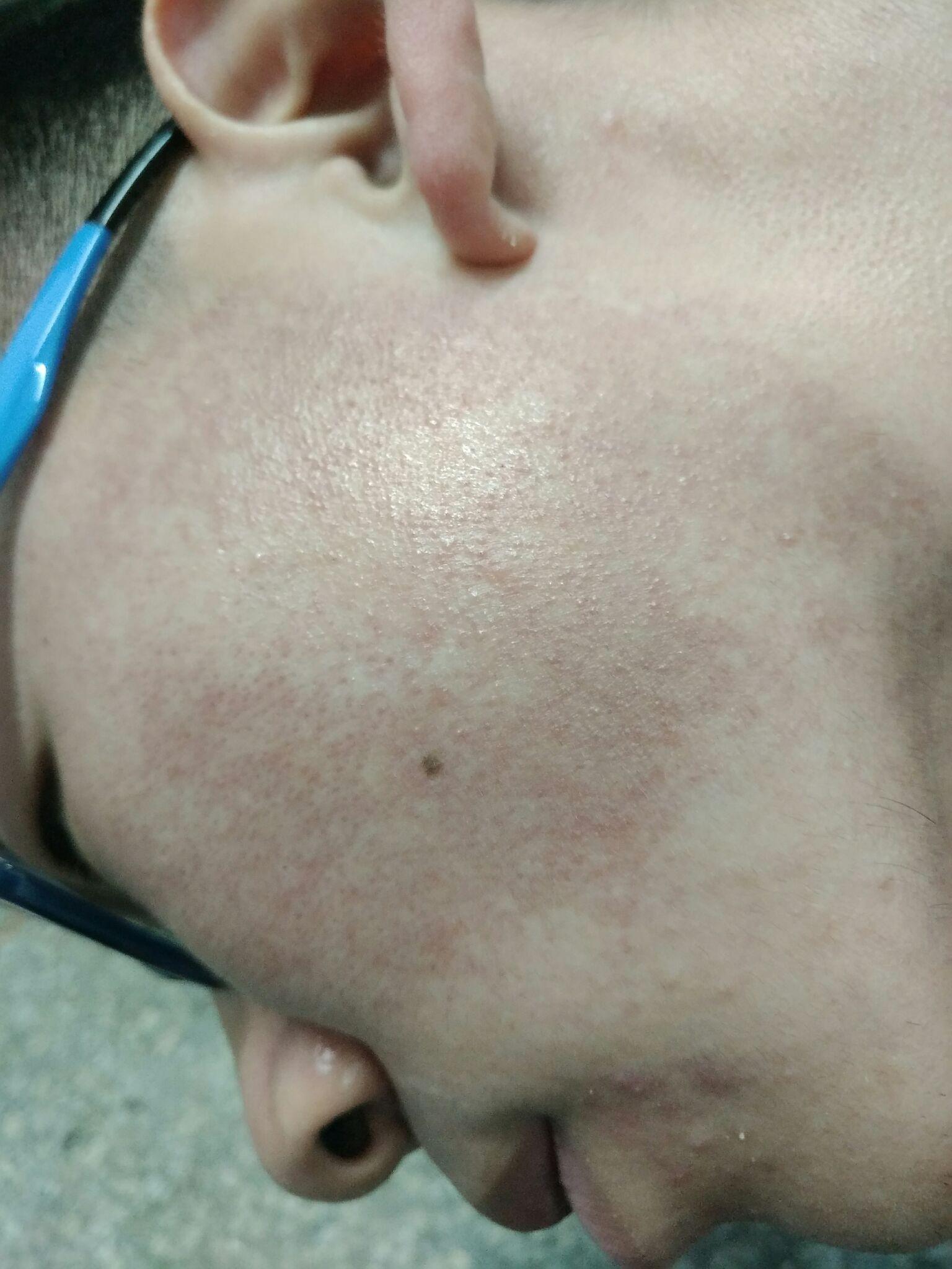 脸上有鸡皮肤能治吗(脸上鸡皮肤可以根治吗)