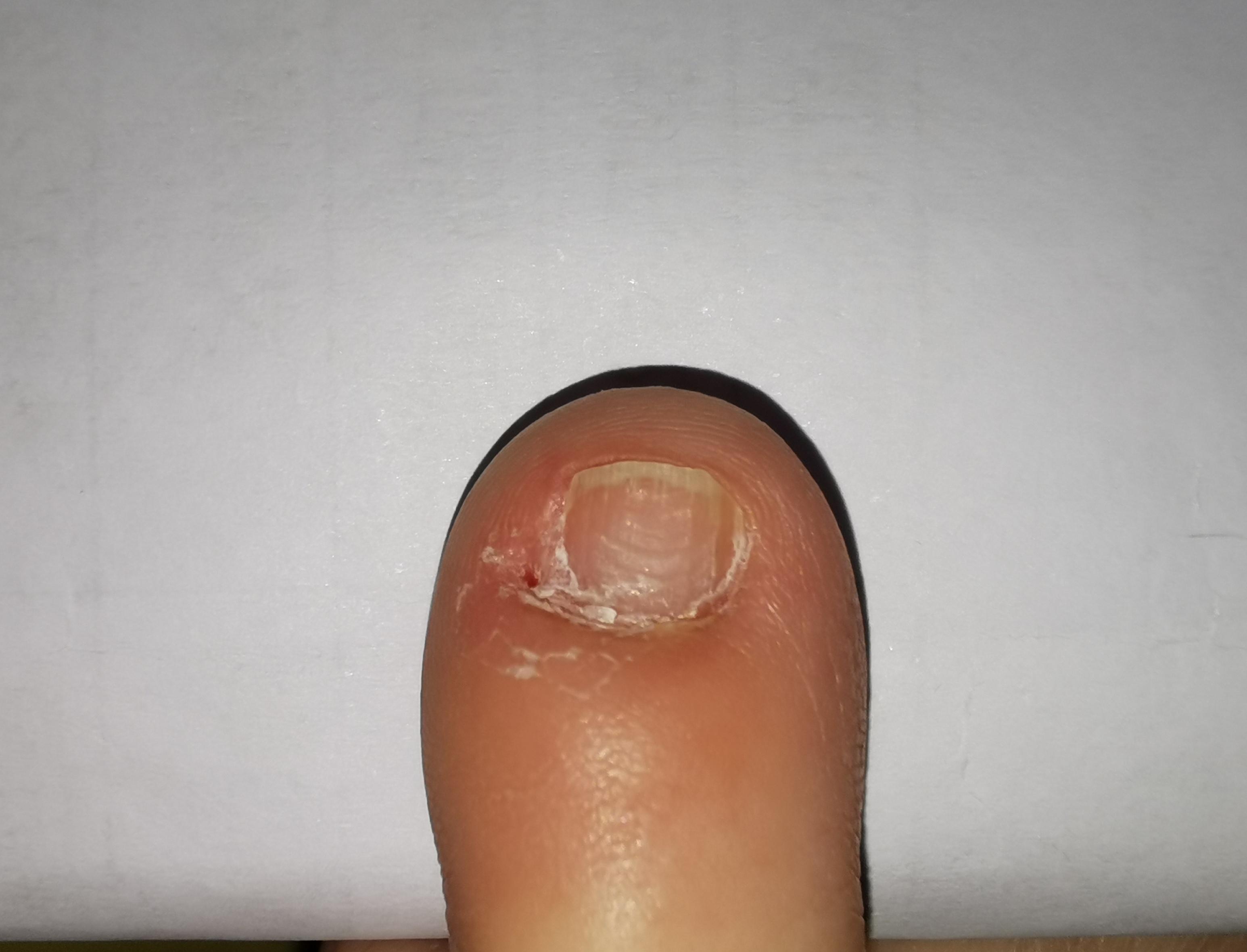 瓣状甲拔了还会长出来吗? - 知乎