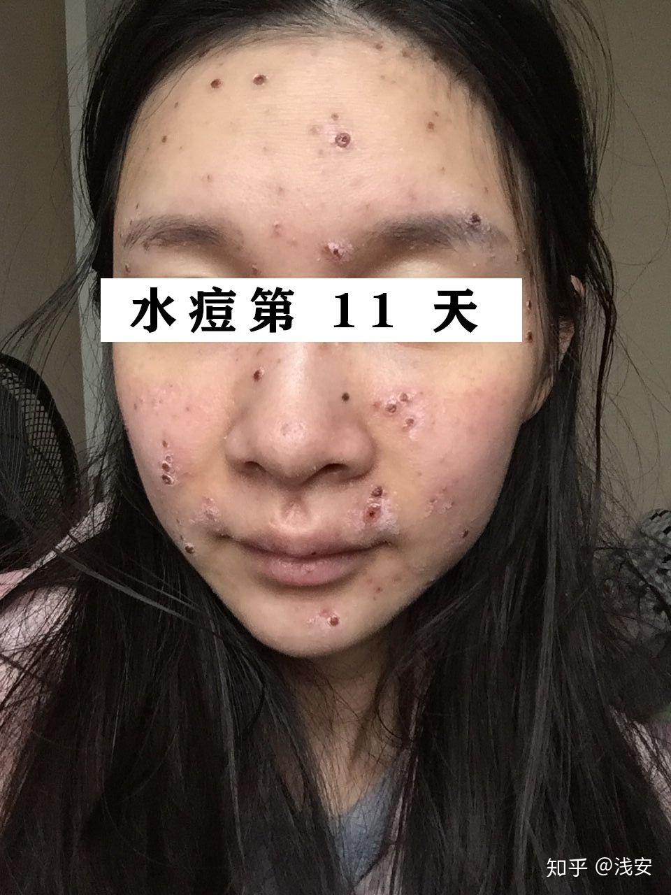 成人长水痘是什么样的经历
