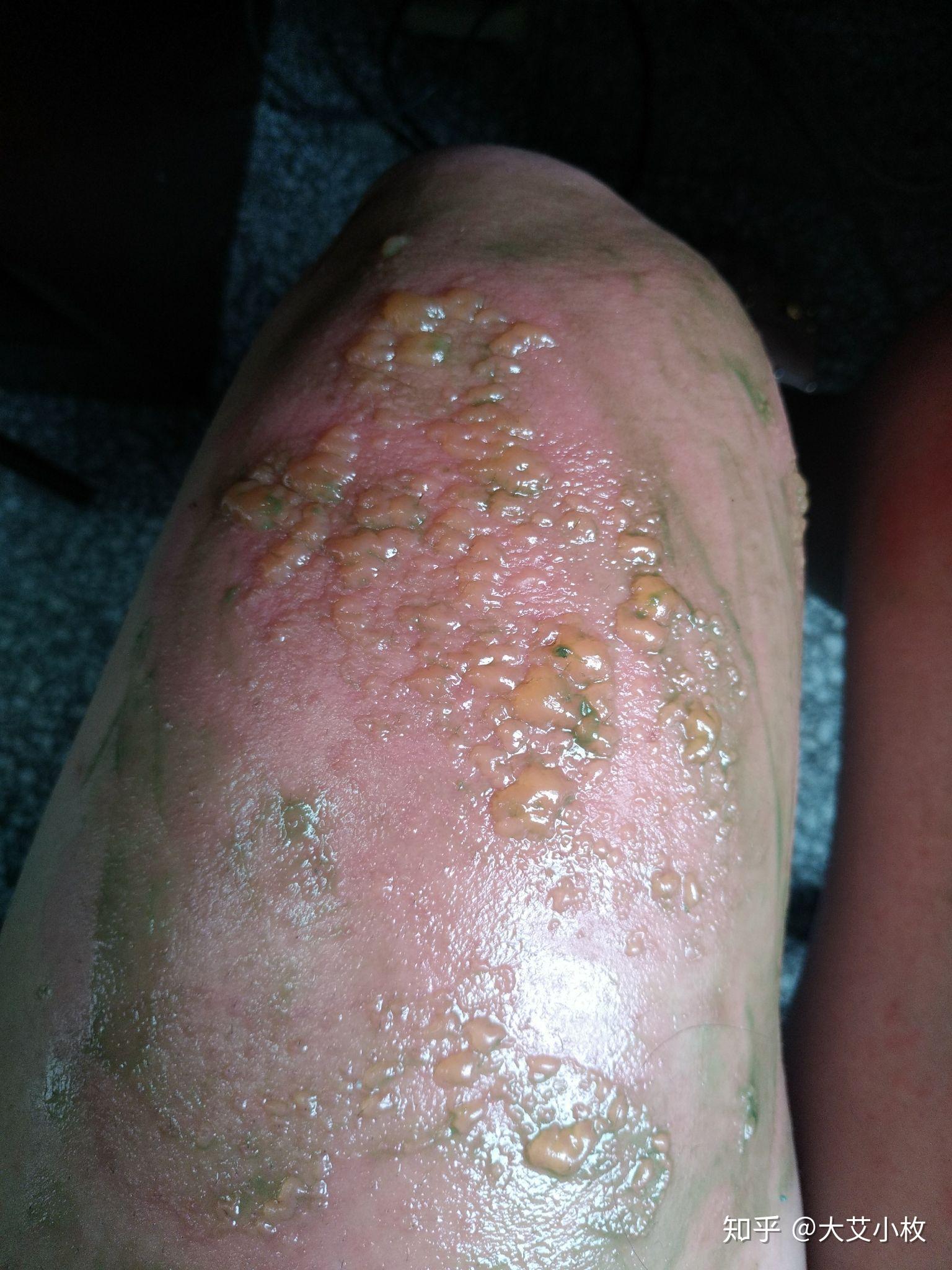 对紫外线过敏是一种怎样的体验?