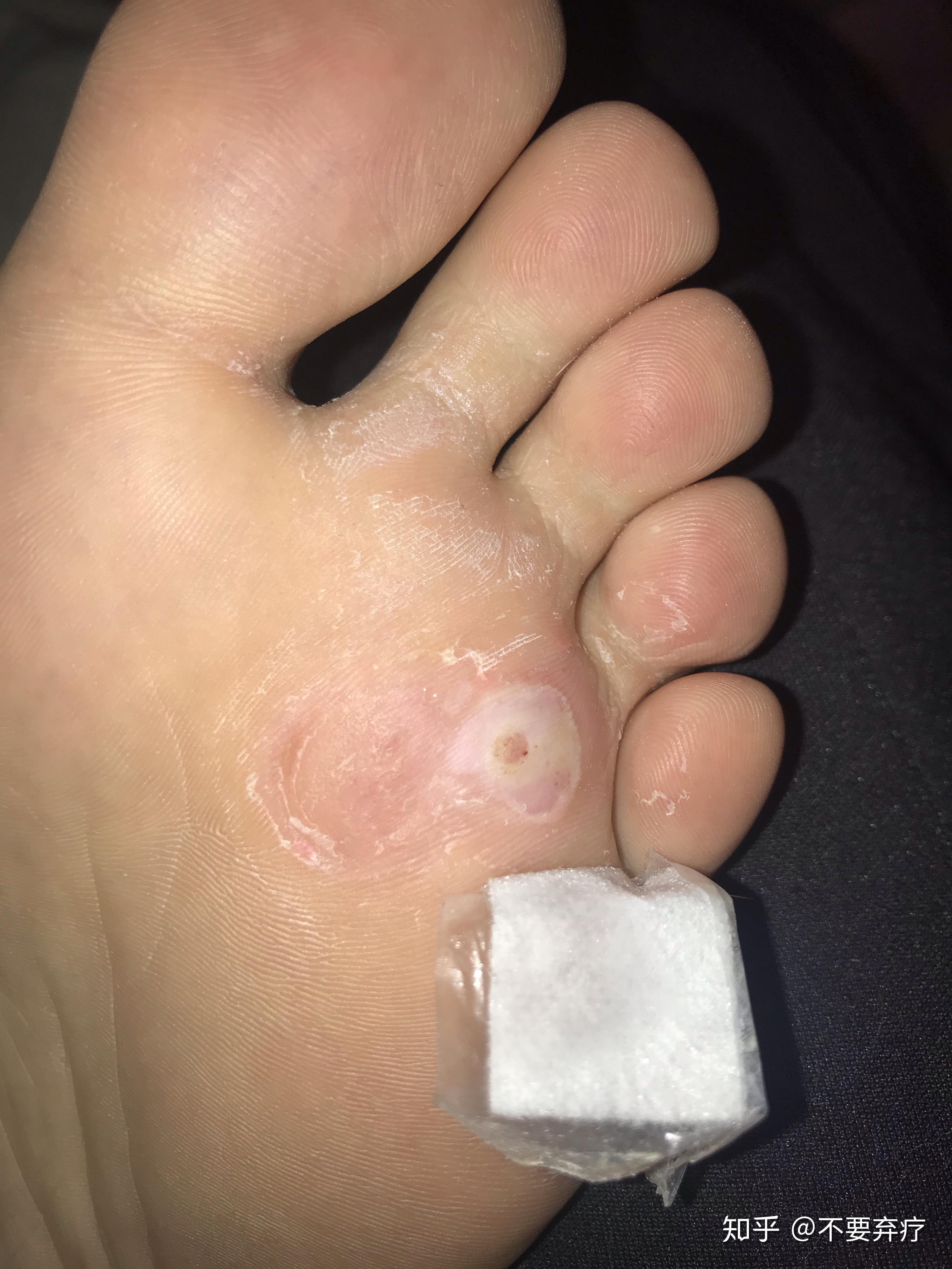 鸡眼怎么彻底挖出