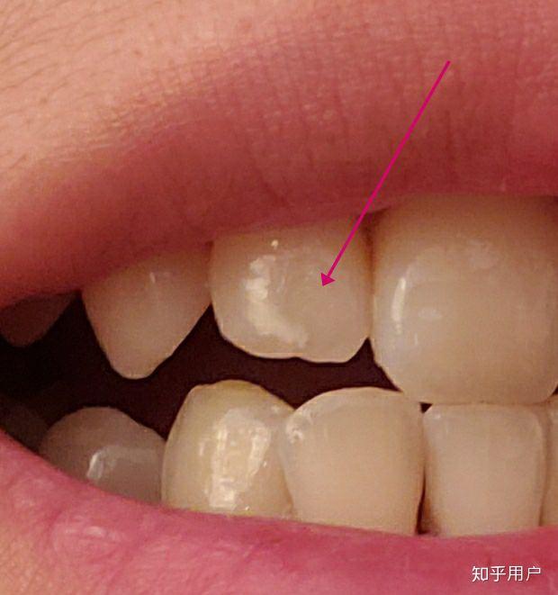 刷完牙齿大门牙突然白了一小块? - 知乎