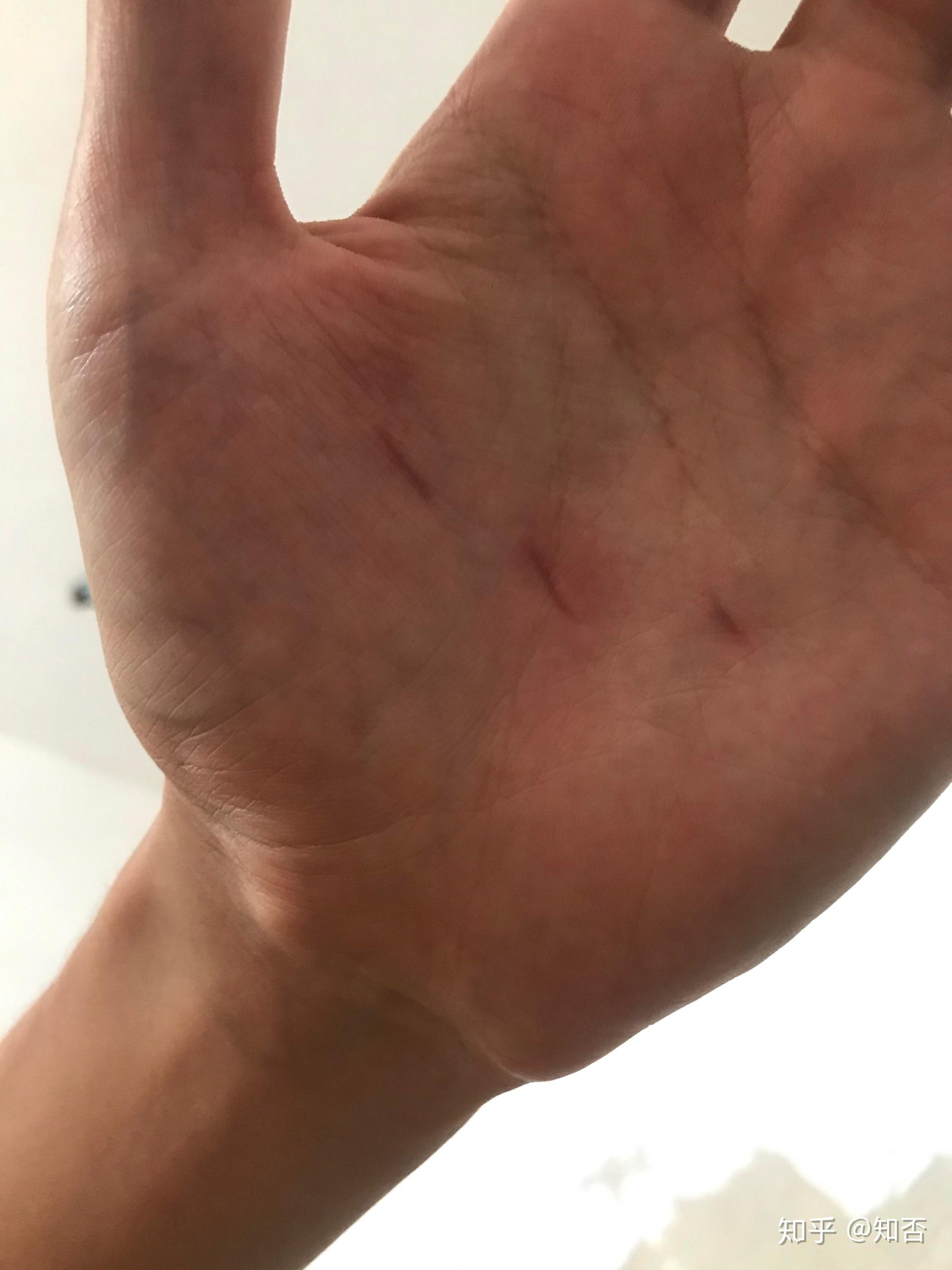 睡觉中经常会紧握住手成拳头状,醒后发现指甲掐的手心很深的印是怎么