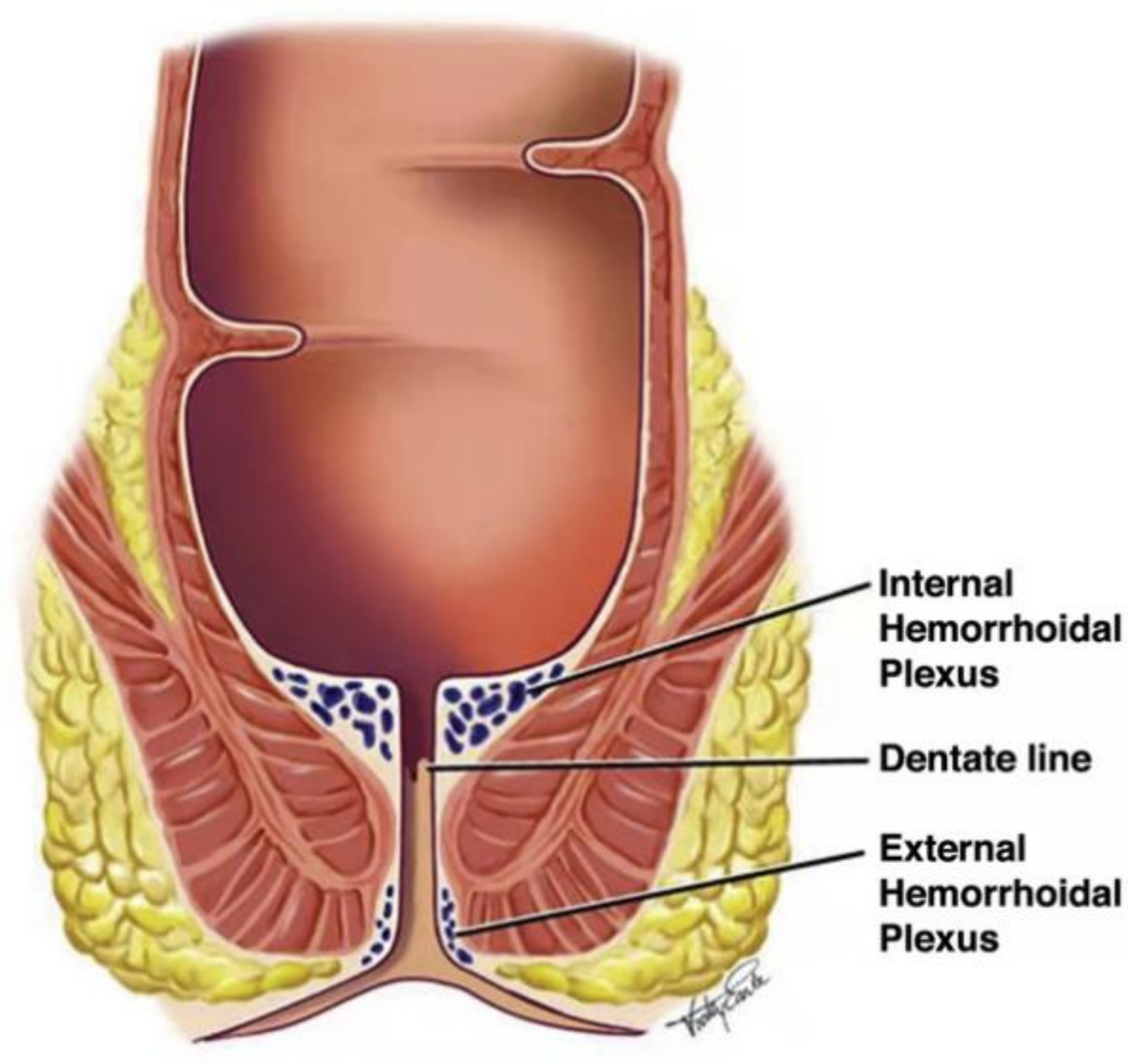 痔疮手术究竟是什么样的
