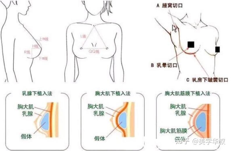 a罩杯隆胸可以到多大