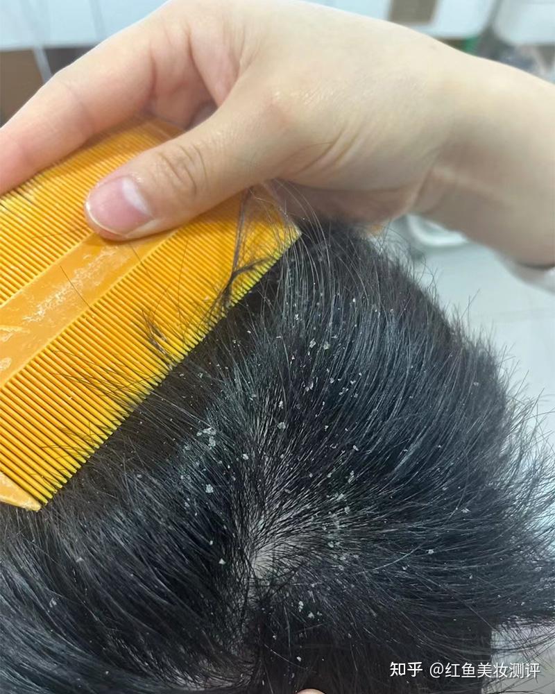 儿童去屑止痒洗发水哪个有效果?去屑最好的洗发水推荐 - 知乎