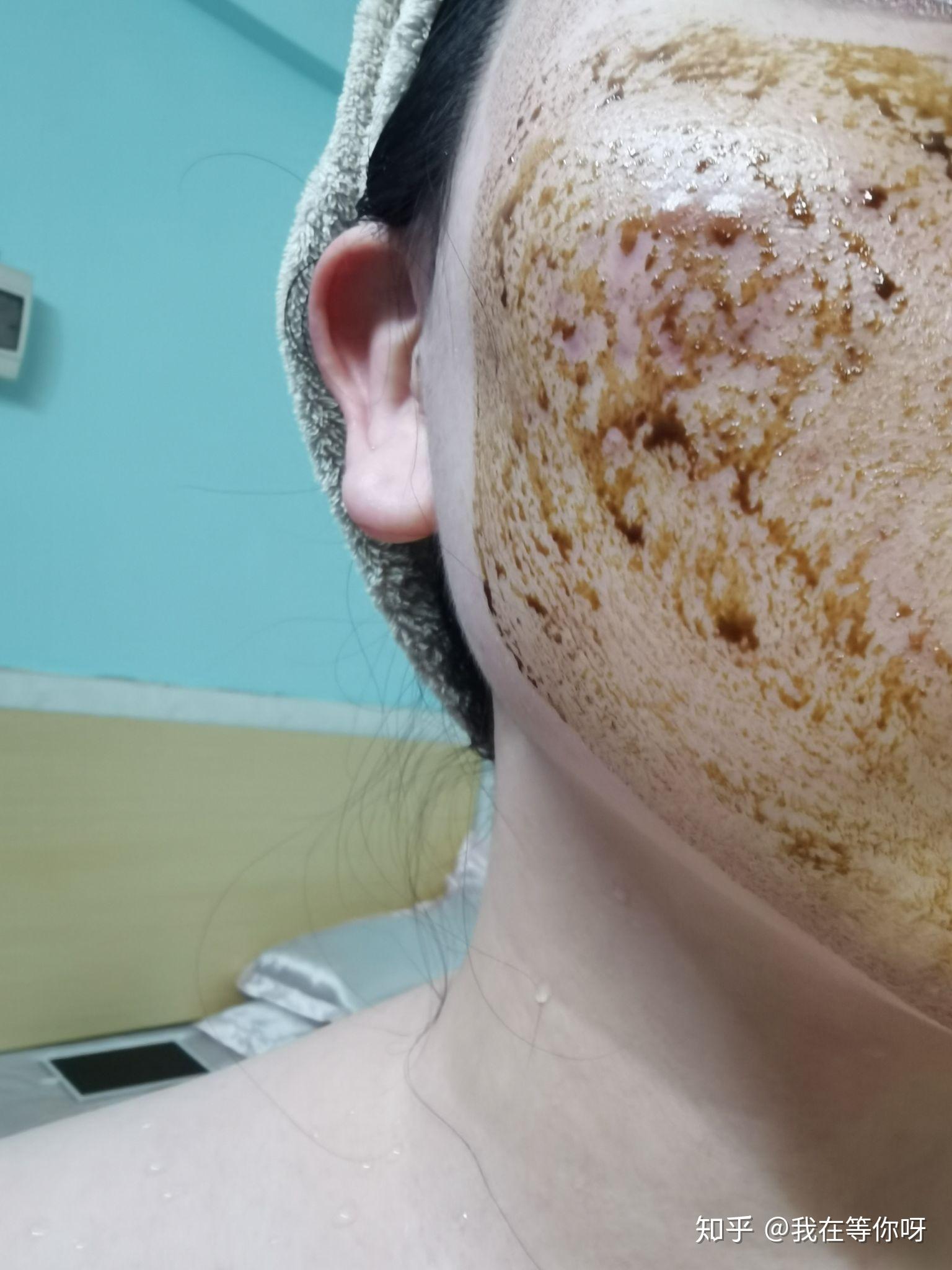 挤痘痘挤到里面成硬块最后能不能消掉啊