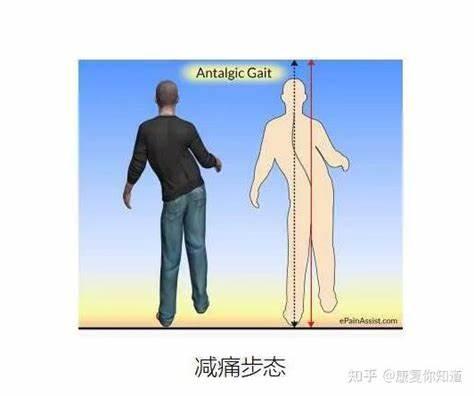 体态矫正——常见异常步态 - 知乎