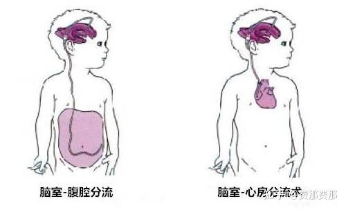 怎样避免分流管分流过度现象？ - 知乎