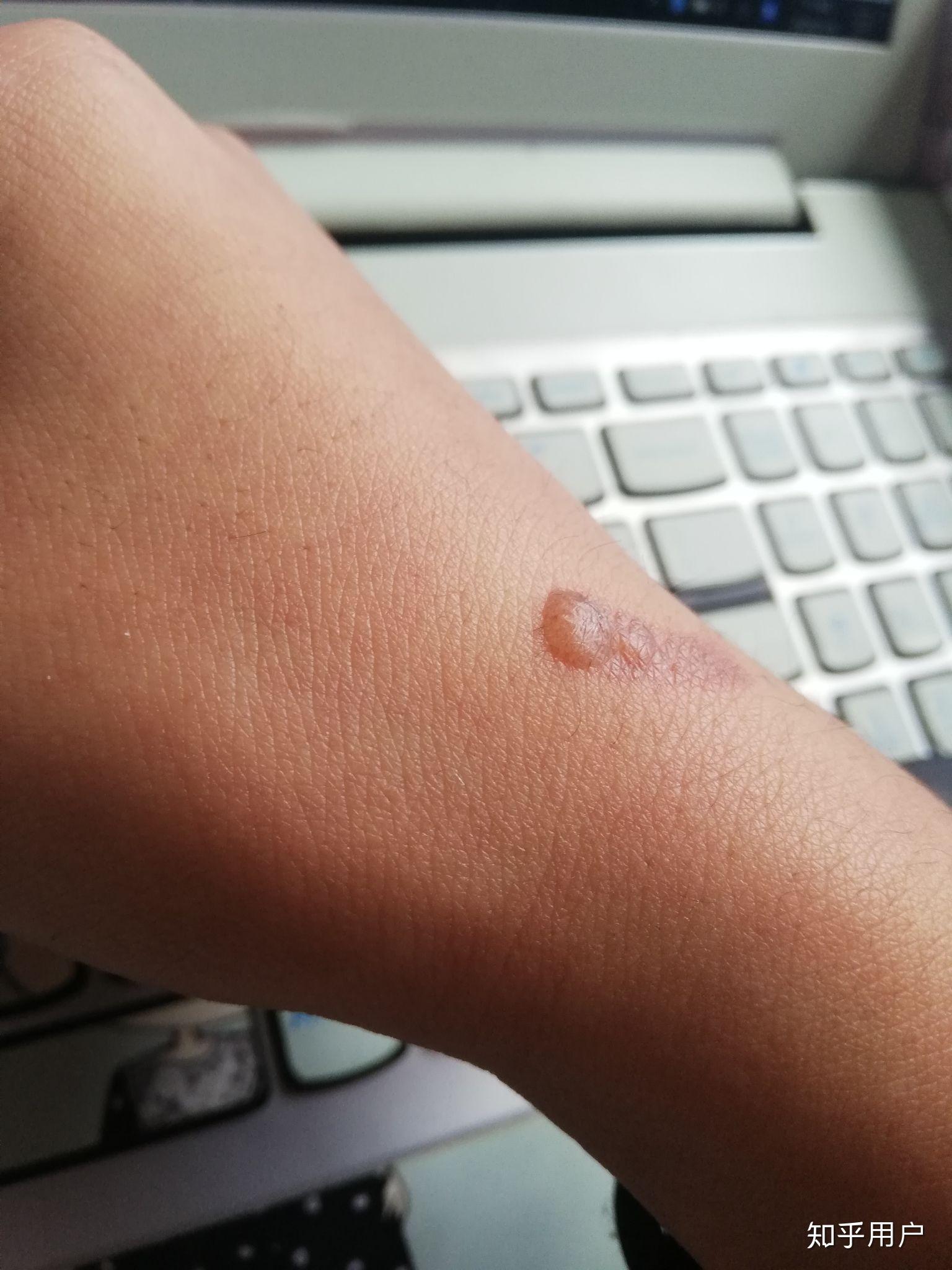 手部被高温烫伤后起的水泡如何处理? - 知乎
