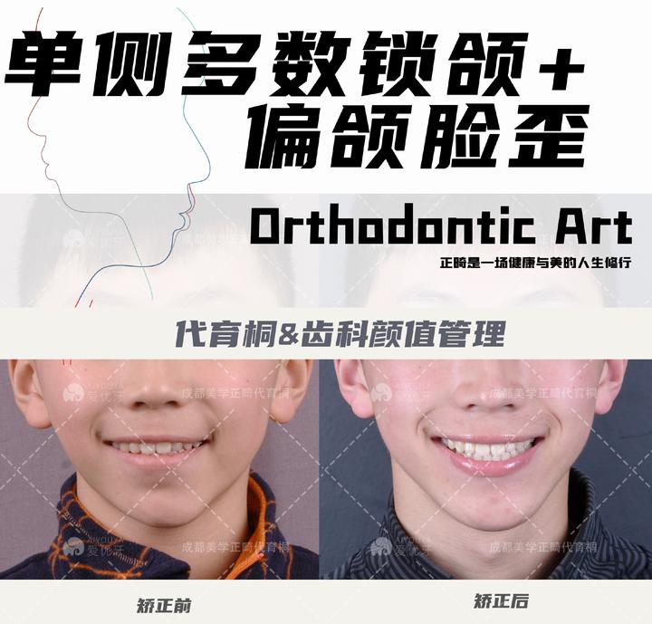 #成都牙齿矫正#成都整牙|单侧多数后牙正锁颌+偏颌脸歪嘴突,正畸回归帅气! - 知乎