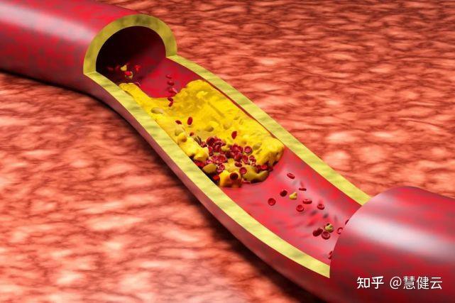 血管硬了,很难再软回去!想要预防改善,一定先要学会“吃” - 知乎
