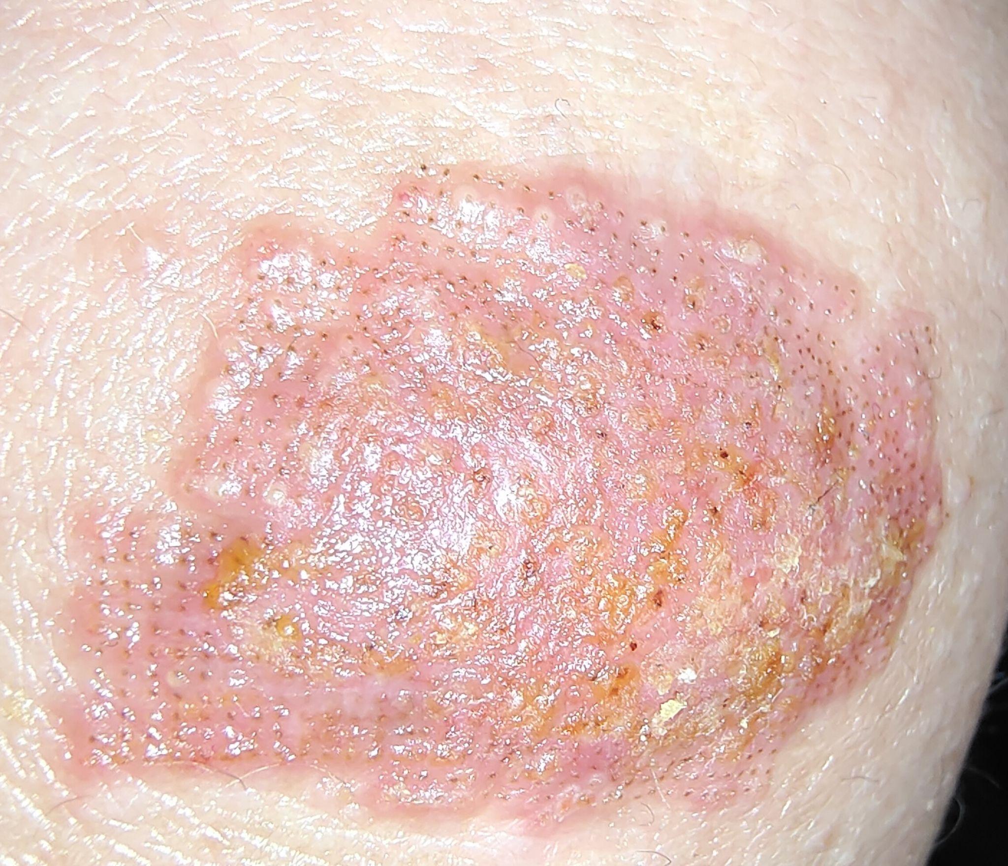 剥落性点阵激光感染和过敏是什么样的? - 知乎