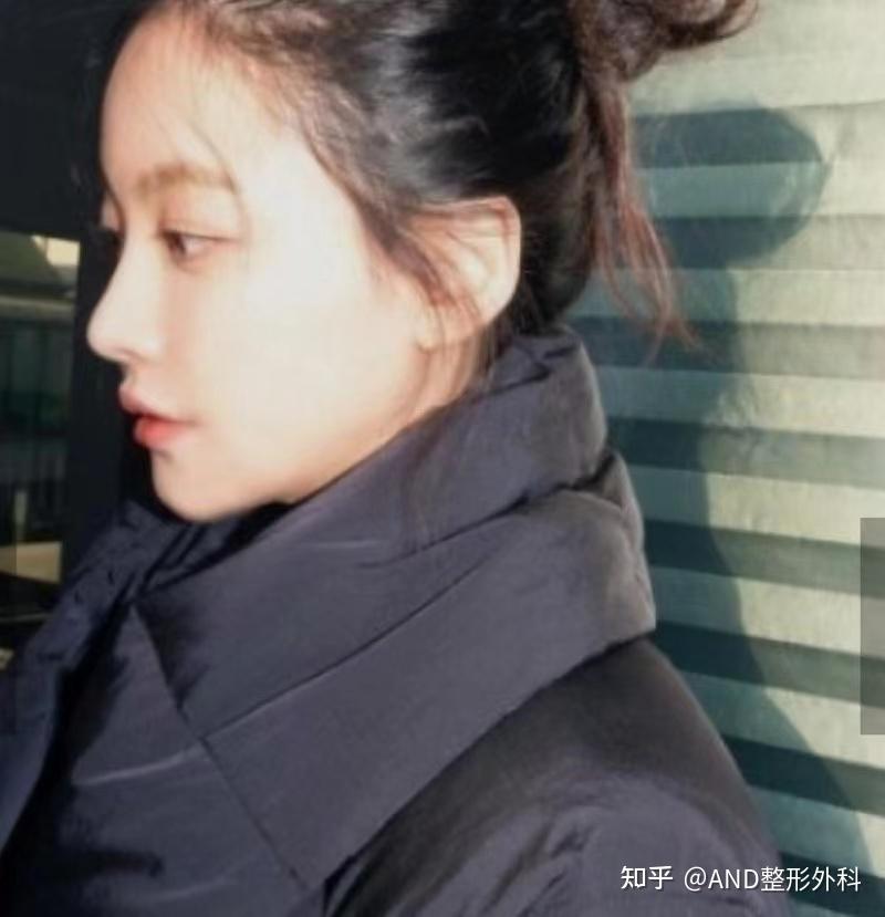 打造吴妍书鼻子般自然、高、细滑的鼻部线条[通过3D打印的艺人鼻部整形]:鼻部再手术（鼻梁整形+鼻尖整形+人中鼻+龙鼻+功能鼻+鼻翼缩小）前后 ...