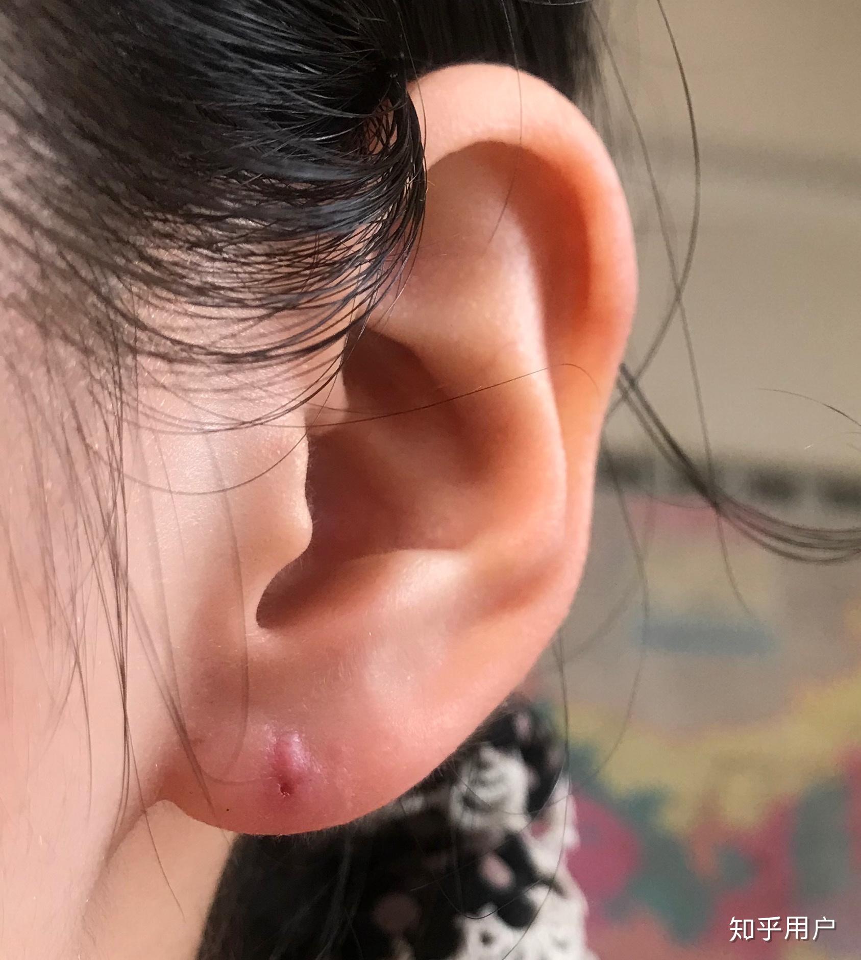 关于之前长死了的耳洞