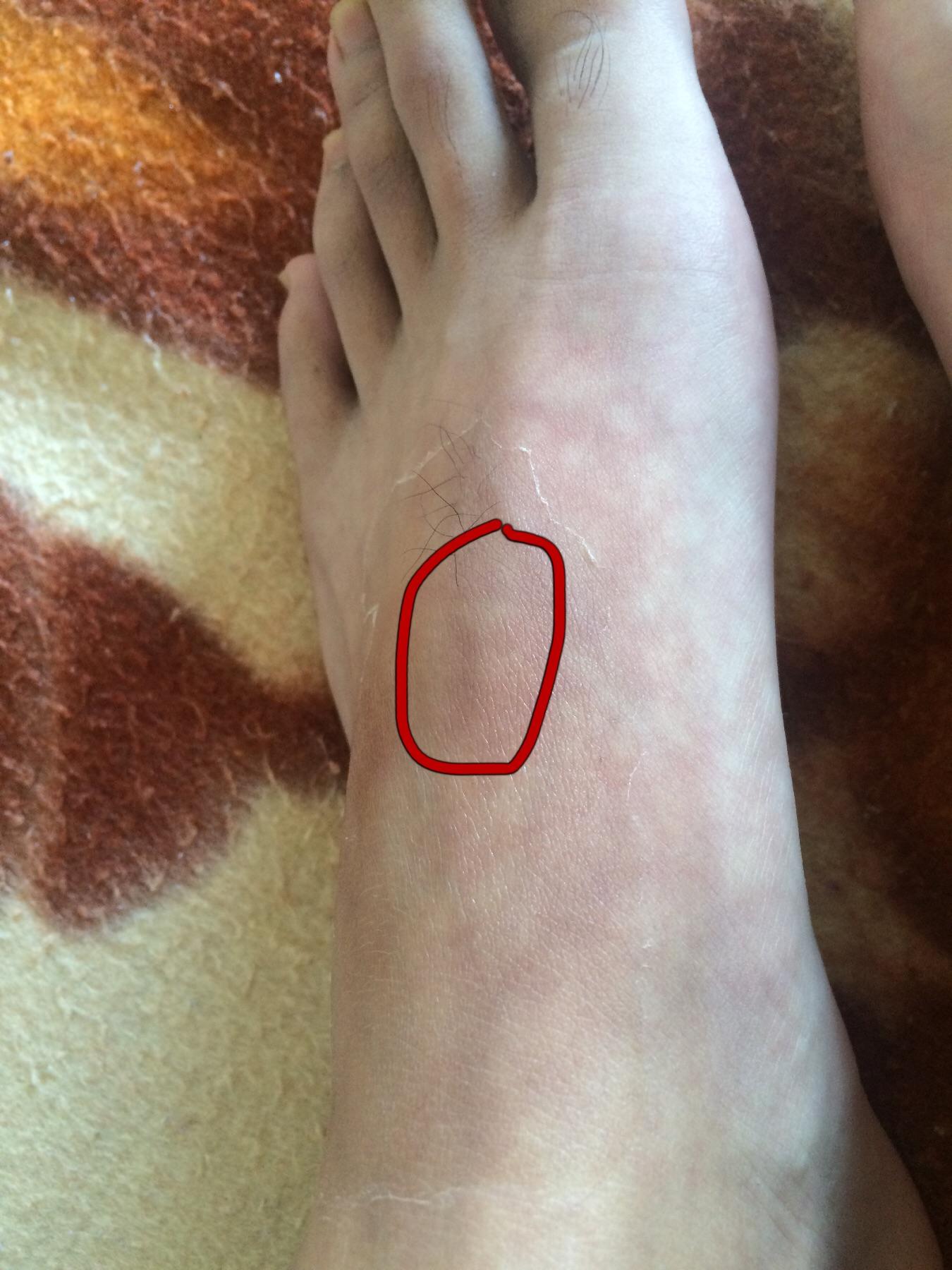 一月前足背拉伤,诊断韧带拉伤,症状走路足背不敢打弯,摸上去像筋附着