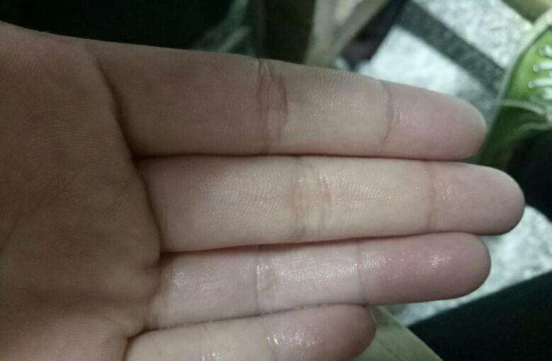 从小到大手上一直有水是什么怪病