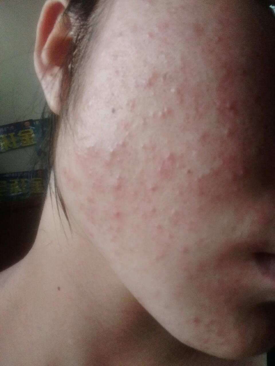 脸上总是反反复复张白头粉刺而且红红的真的很心病该怎么办