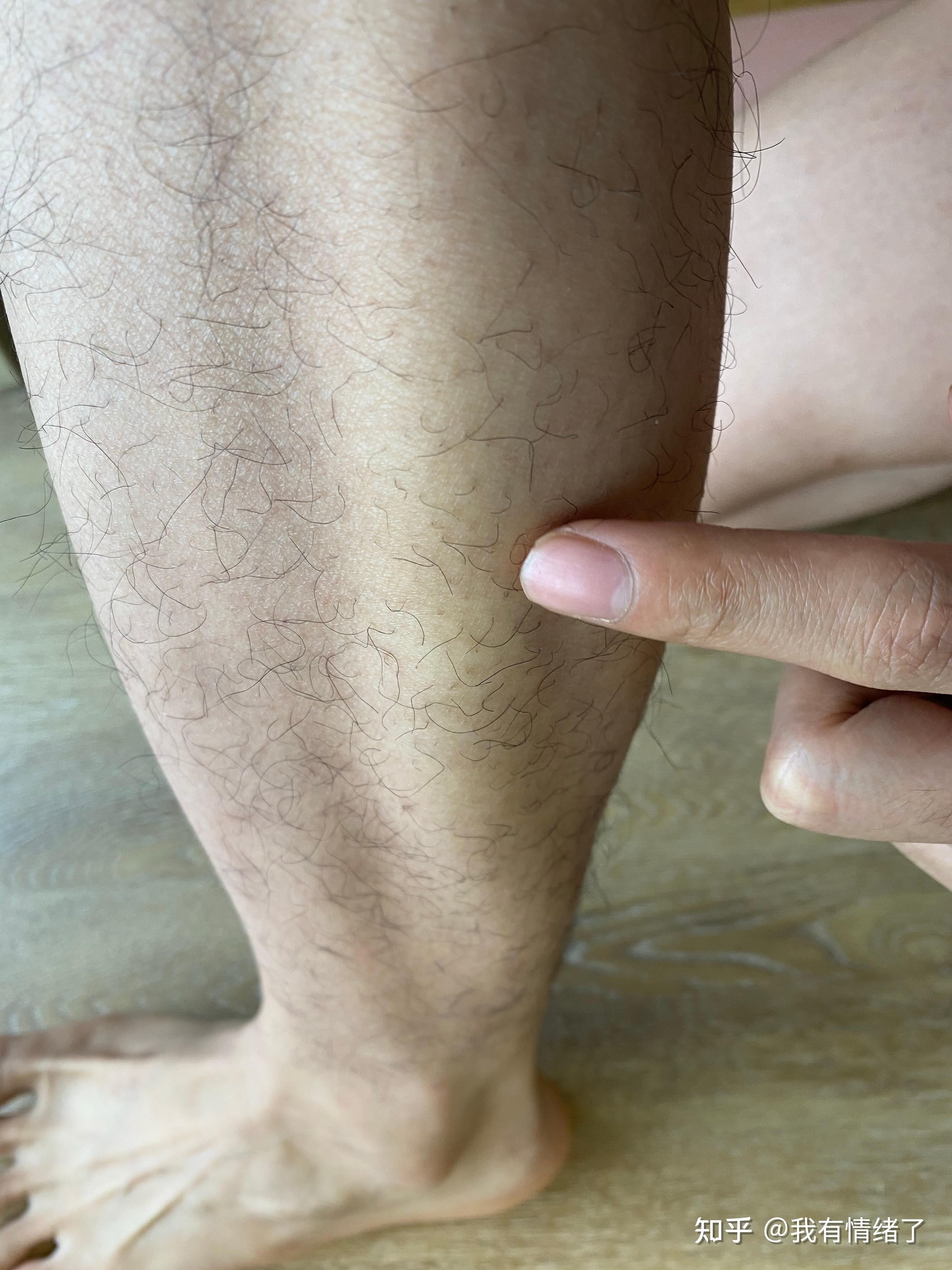 小腿内侧凹陷?好像是运动以后就有了 只有一侧有?