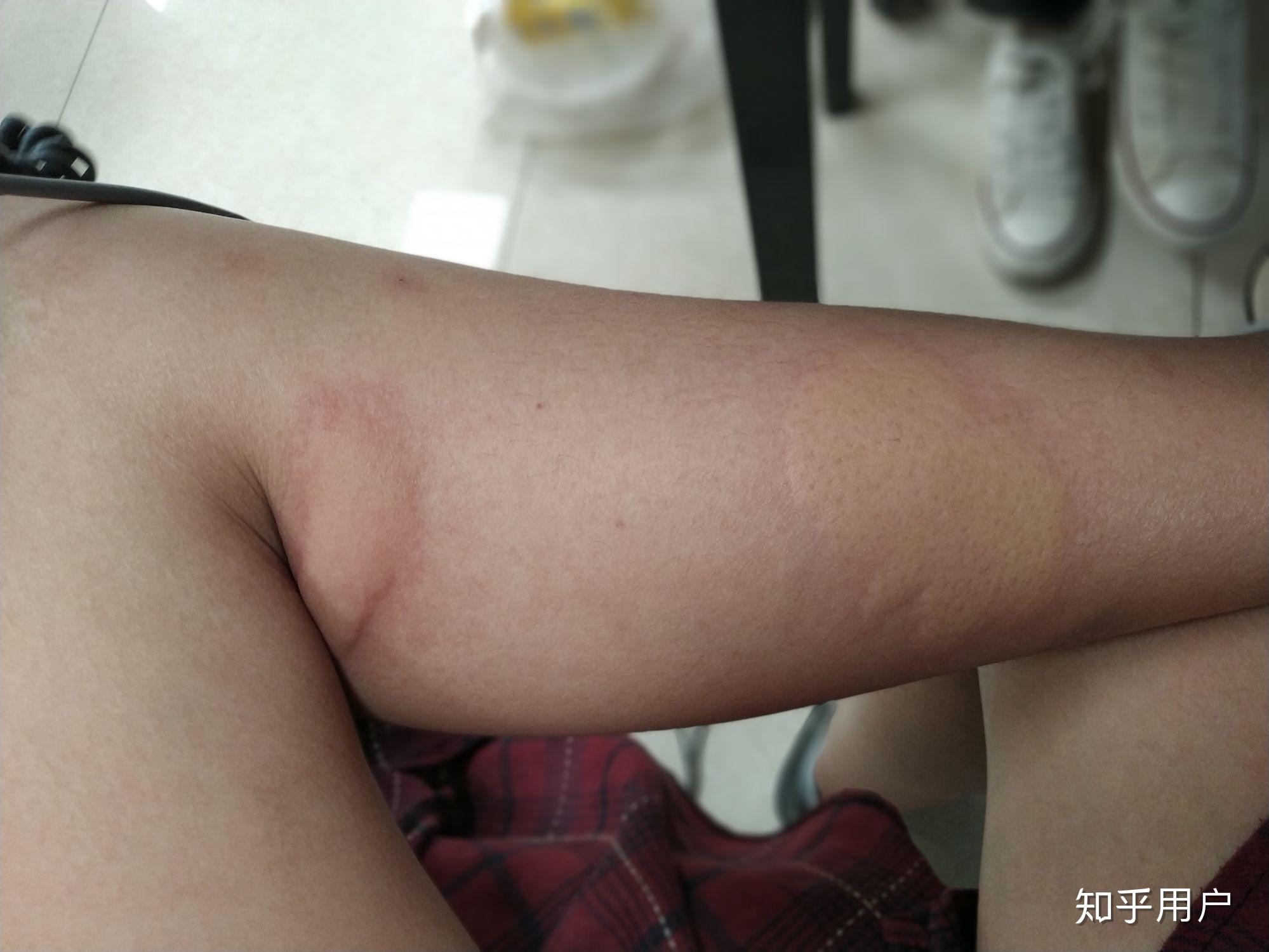 你们被蚊子咬过最大的包有多大咬的位置在哪里