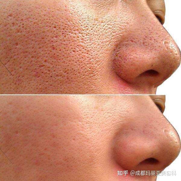 男生脸部毛孔粗大该如何改善? - 知乎