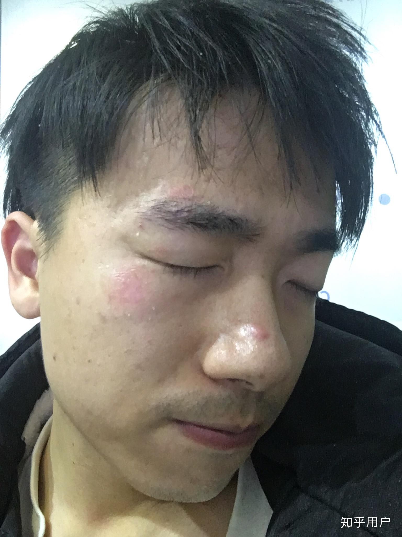 脸部擦伤如图,请问如何恢复? - 知乎