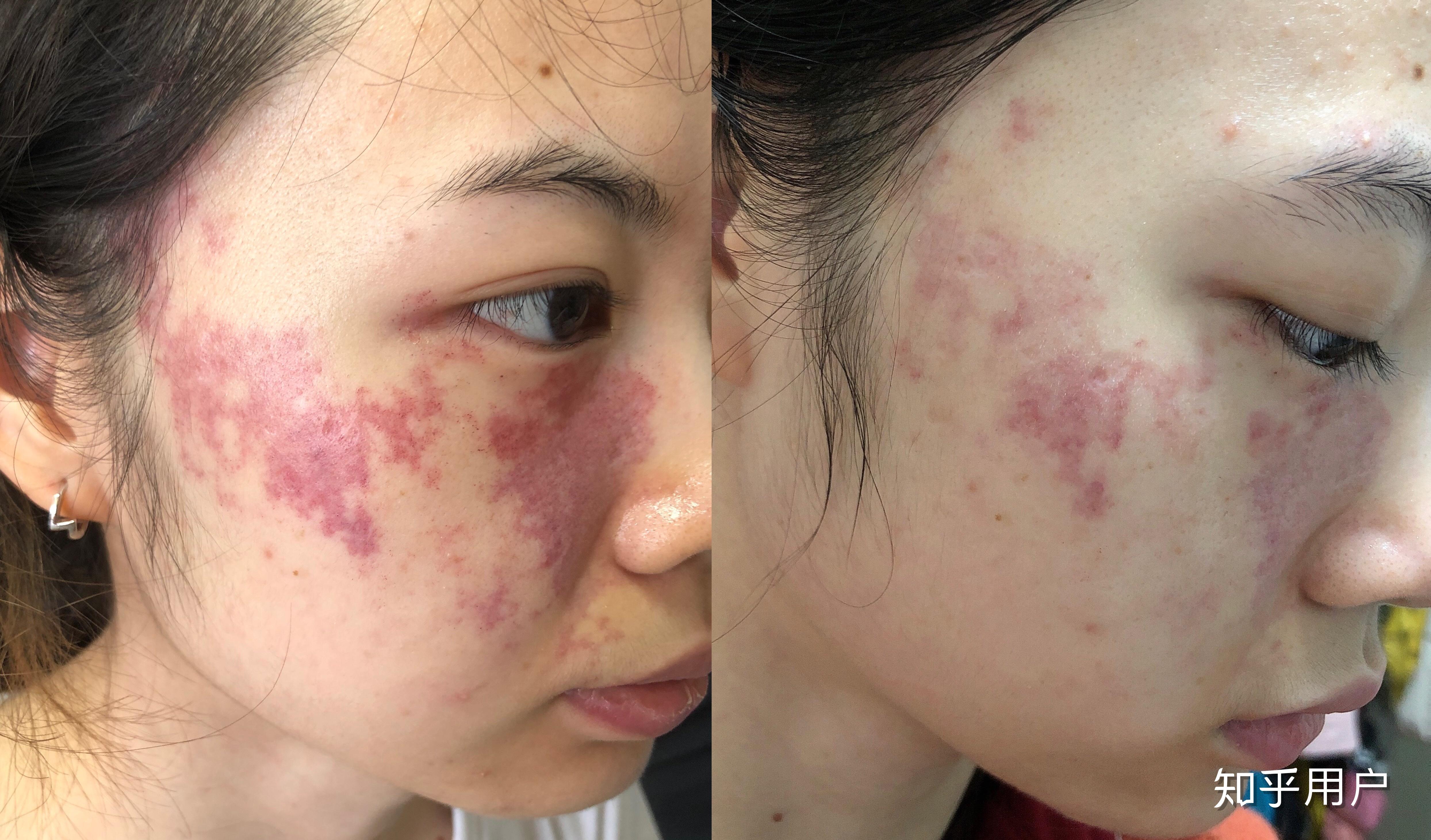 脸上有胎记是一种怎样的体验?