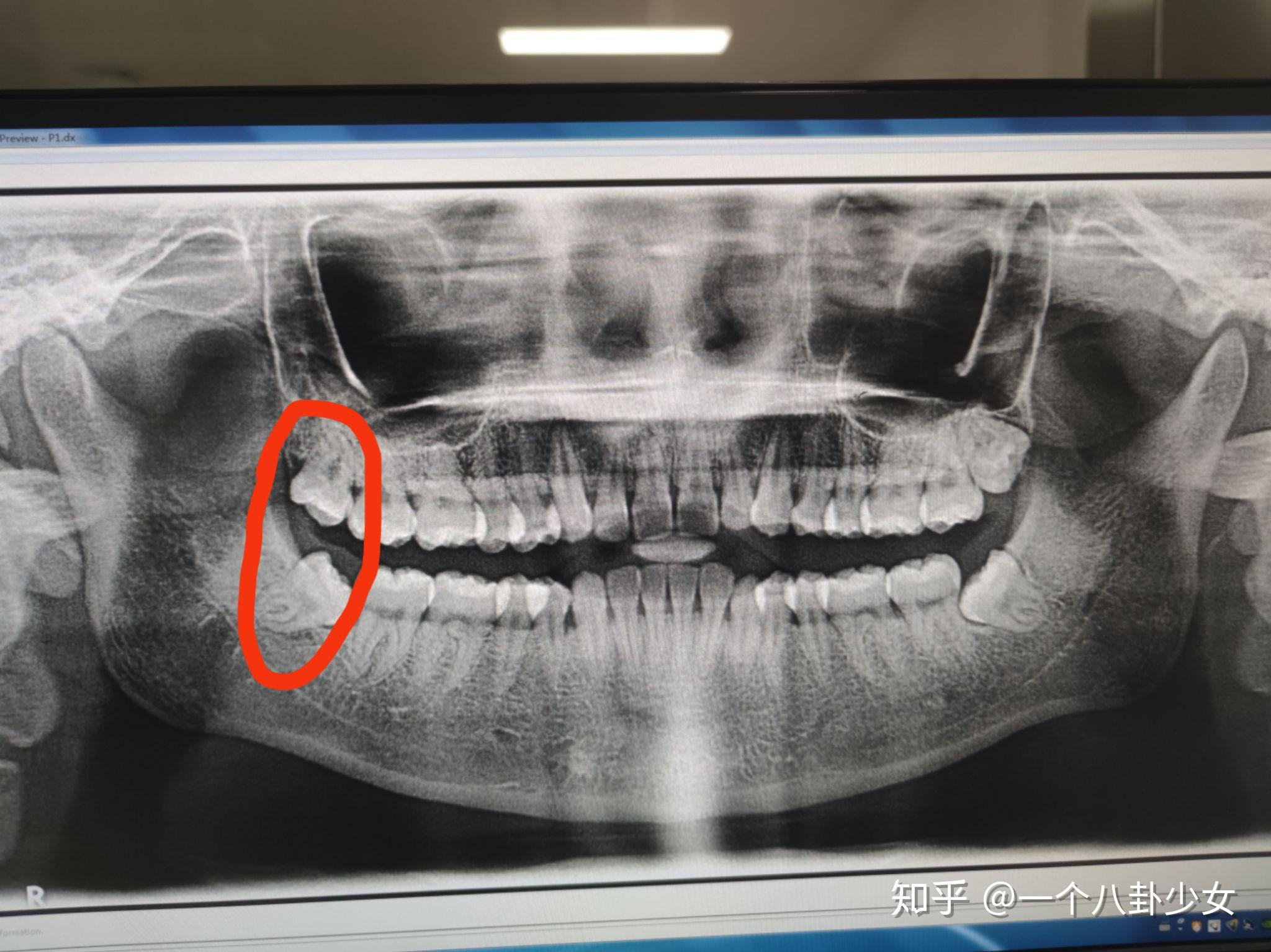 拔智齿后,你吃什么?愈合过程记录? - 知乎