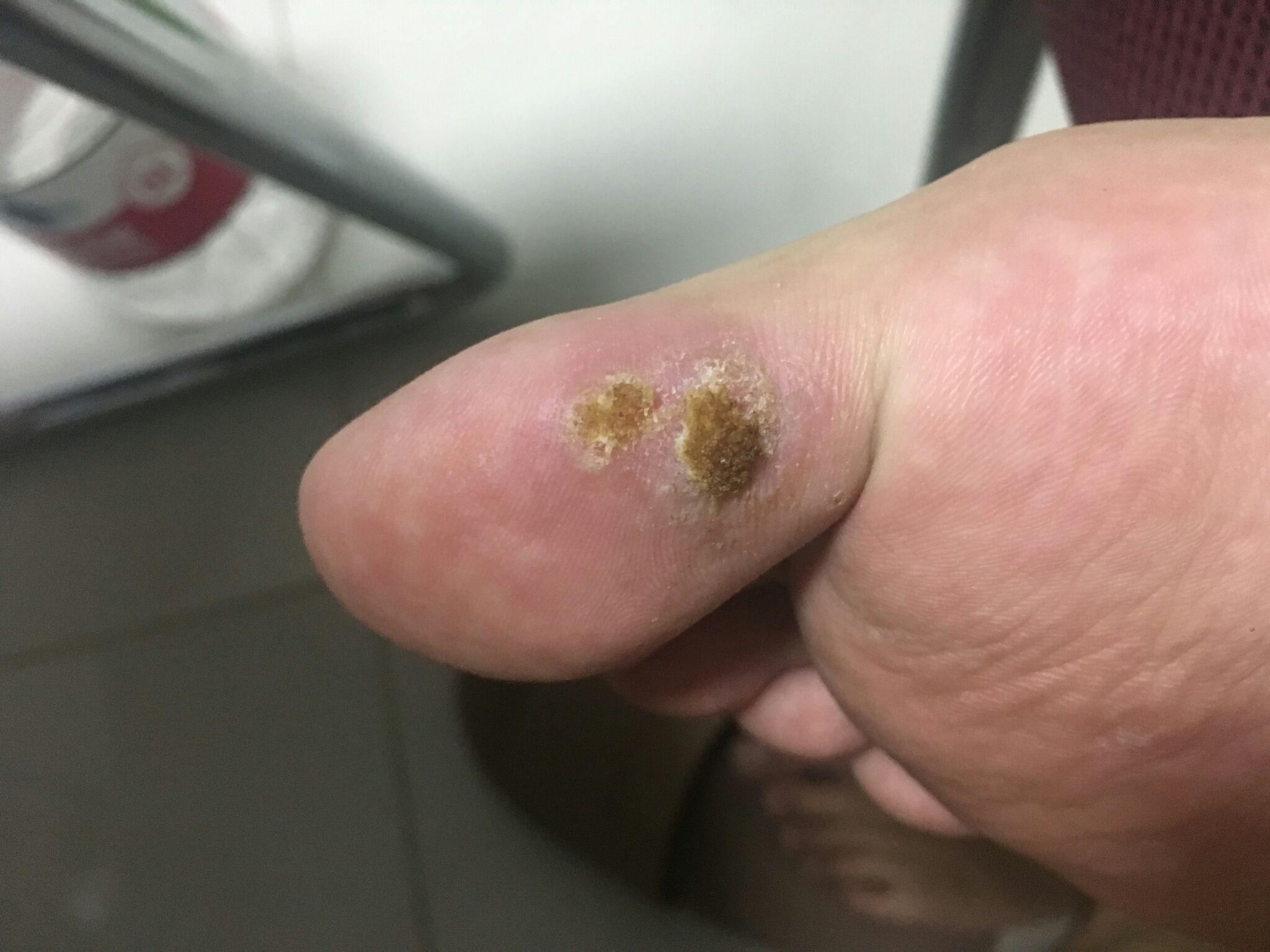 这个跖疣怎么治