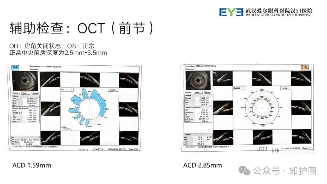 PPT】眼科疑难病例讨论：晶状体源性急性闭角型青光眼护理查房- 知乎