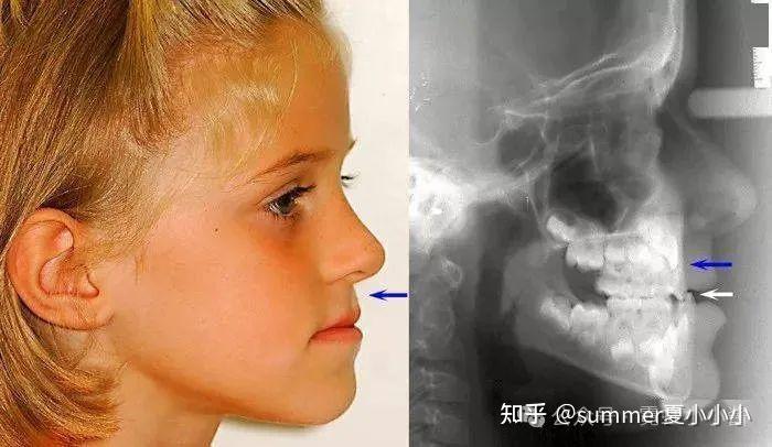 舌头贴上颚,能让鼻基底变高、脸变立体变好看? - 知乎