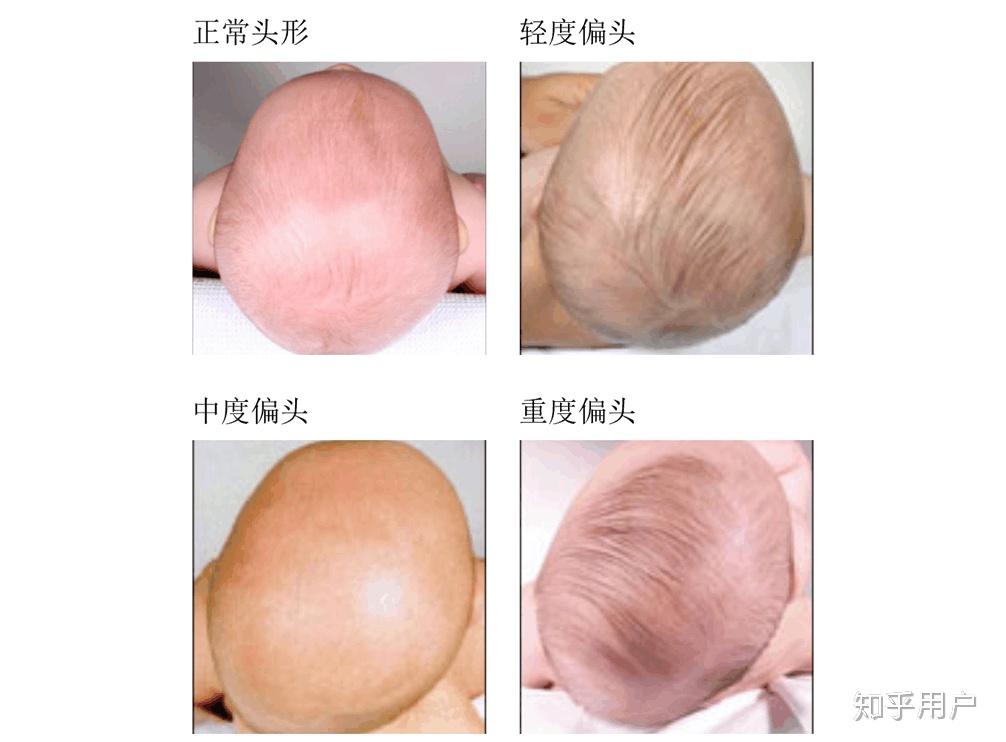 新生儿后脑勺凹进去好还是凸出来好? - 知乎