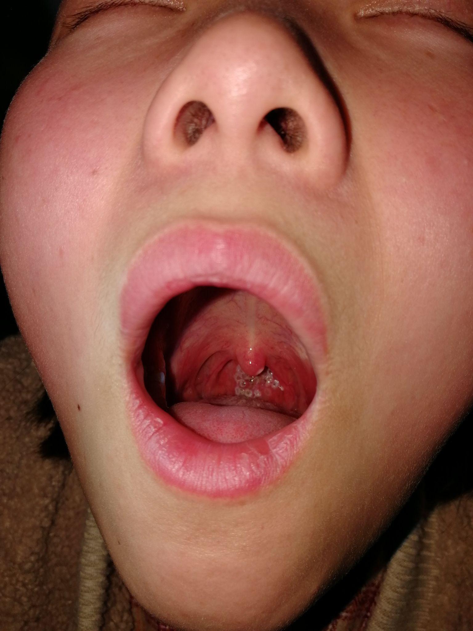 请问效果如何?现在被咽喉炎弄得无法正常说话 想一次性治好 ?