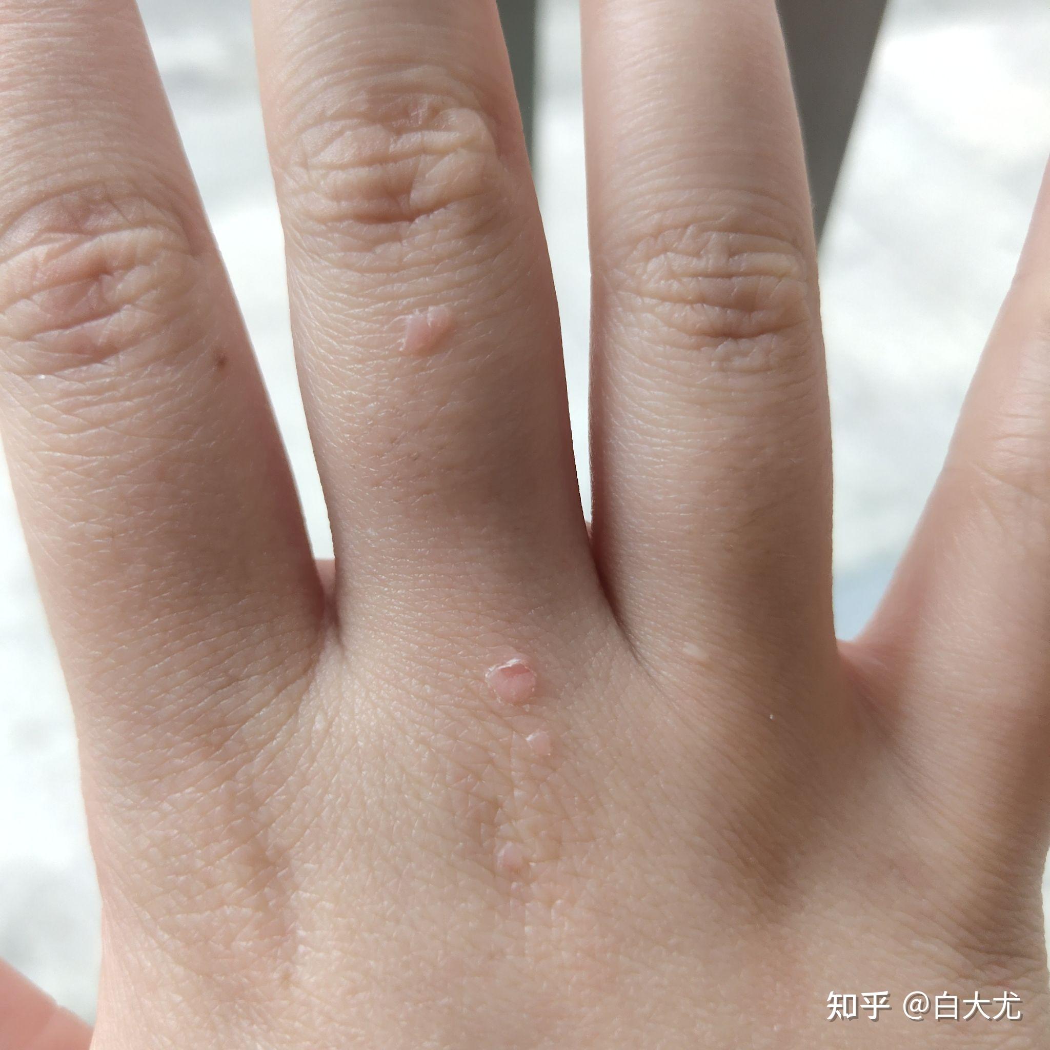 手上有红色的小点不痛不痒