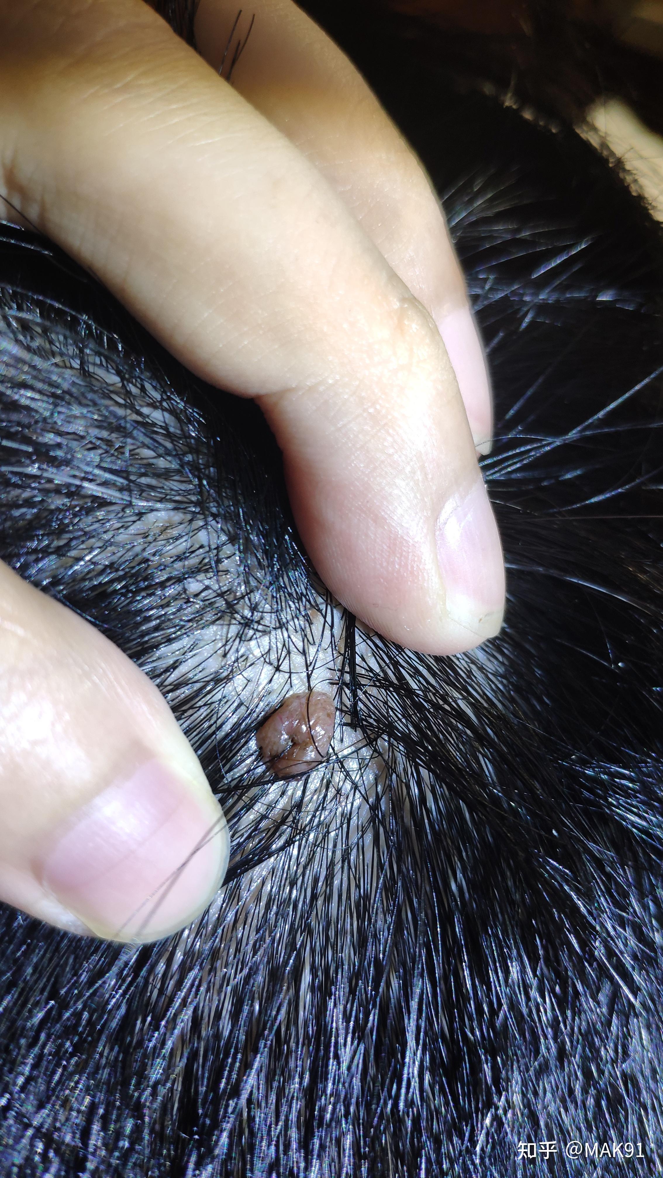 头皮上长了一个红色的小肉球不疼不痒的问一下是啥? - 知乎