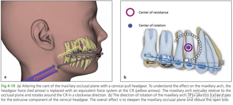 Chapter 4 头帽口外弓 headgear 4 - 知乎