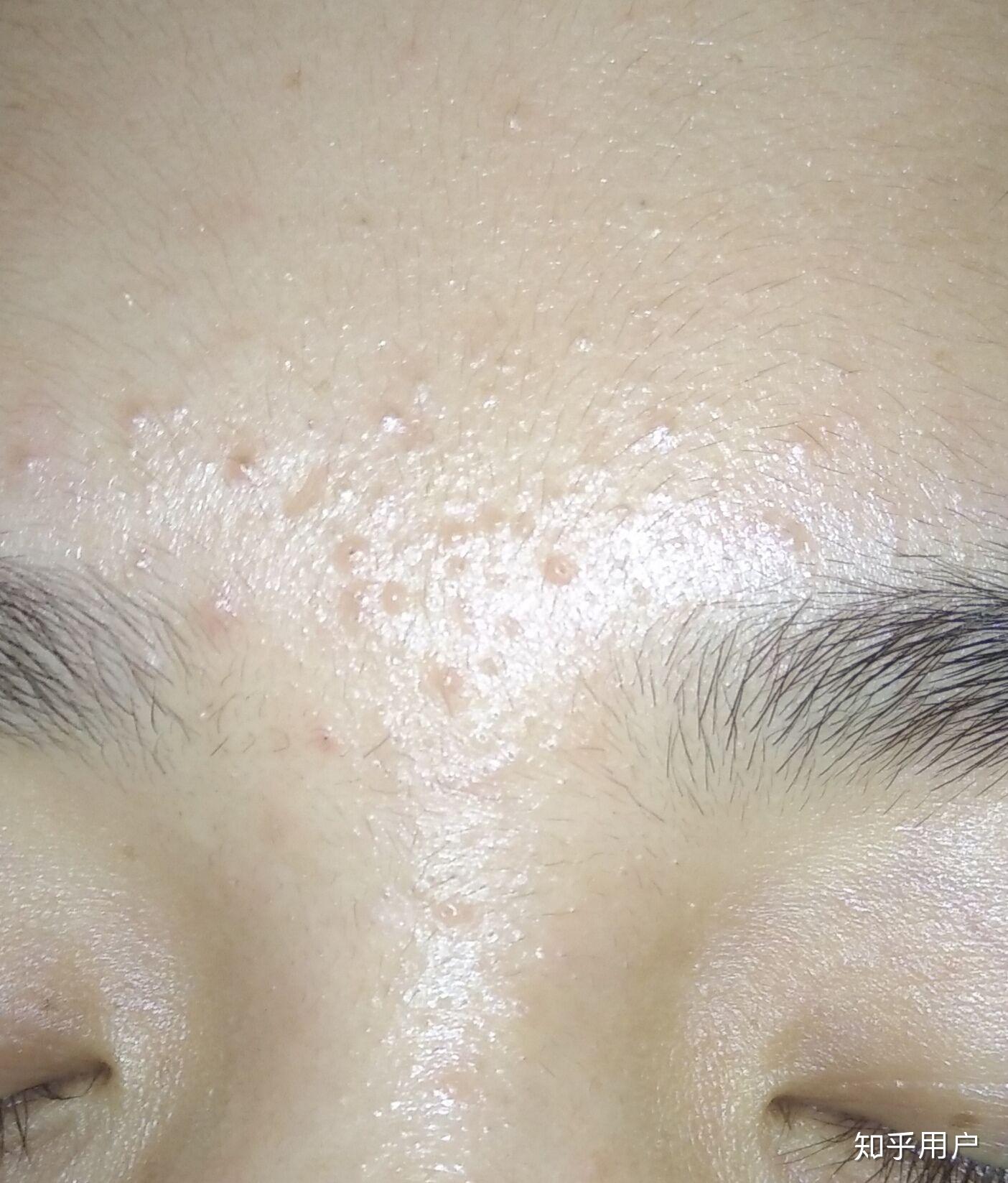额头上和眉心长了好多小疙瘩,不会变严重,也一直不消,有的还能抠出来
