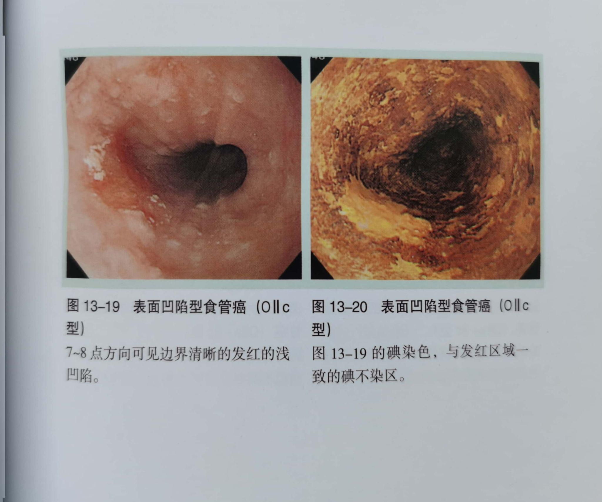 食管癌早期胃镜下图片图片