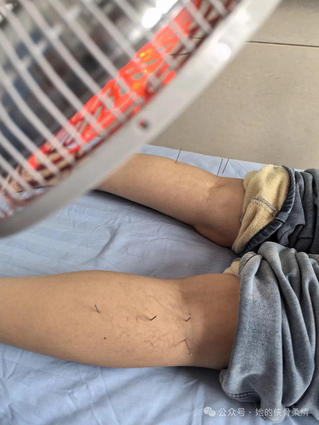 掀开衣裤一看腘窝跟舌苔一样触目惊心 腰痛委中求中药喝不下去要
